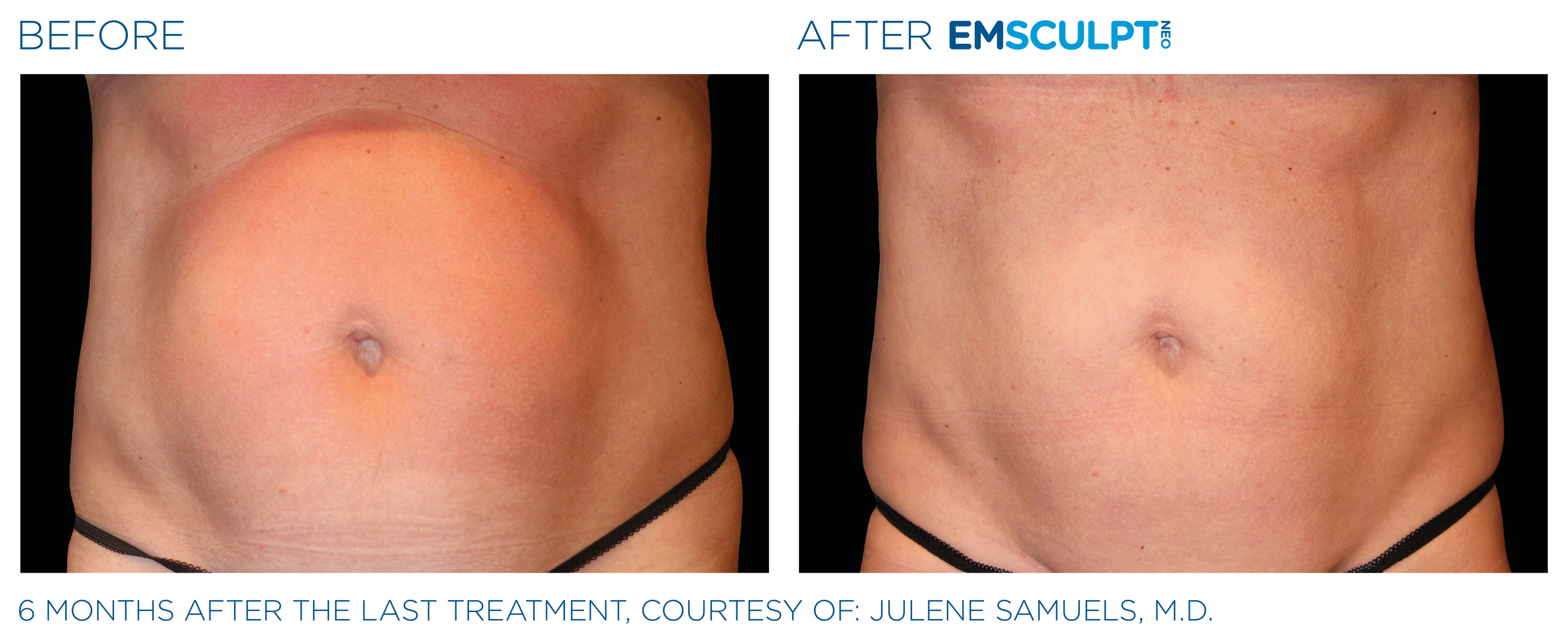 AbdomenEmsculpt_neo_PIC_Ba-card-female-abdomen-039_ENUS100.png
