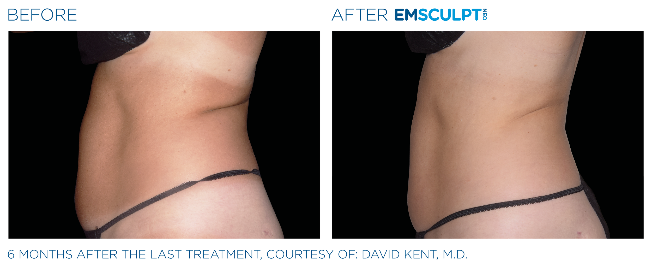 AbdomenEmsculpt_neo_PIC_Ba-card-female-abdomen-044_ENUS100.png