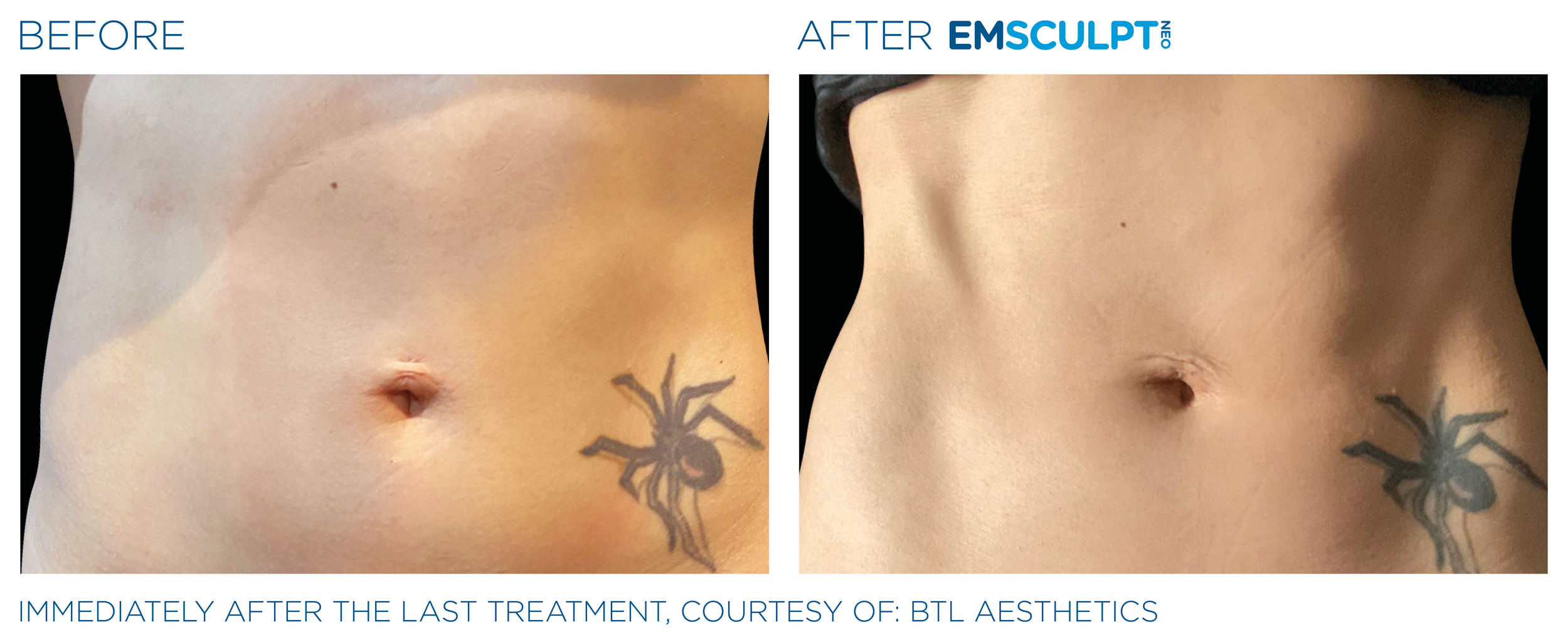 AbdomenEmsculpt_neo_PIC_Ba-card-female-abdomen-048_ENUS100.png