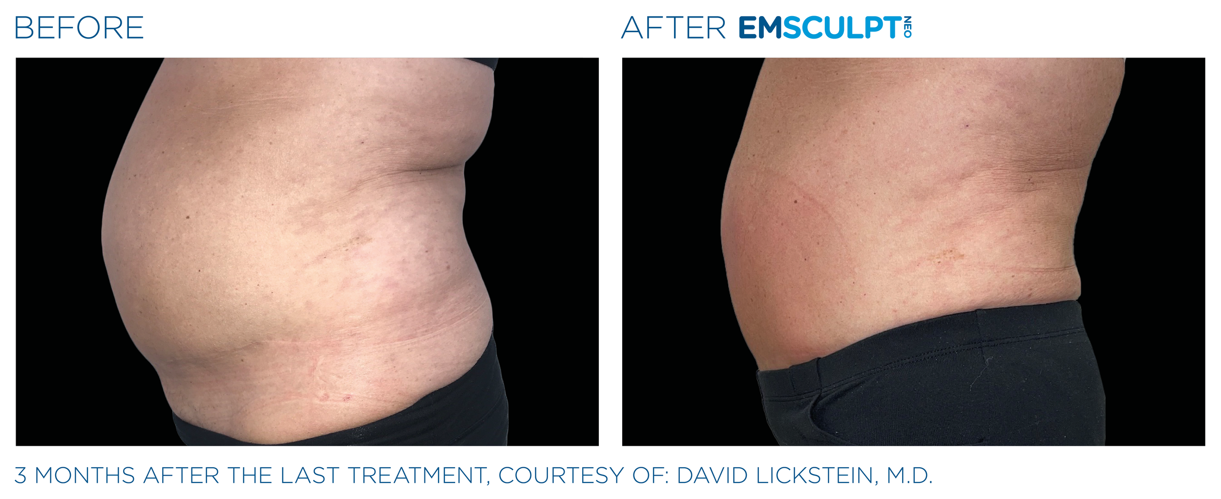 AbdomenEmsculpt_Neo_PIC_Ba-card-female-abdomen-137_ENUS100.png