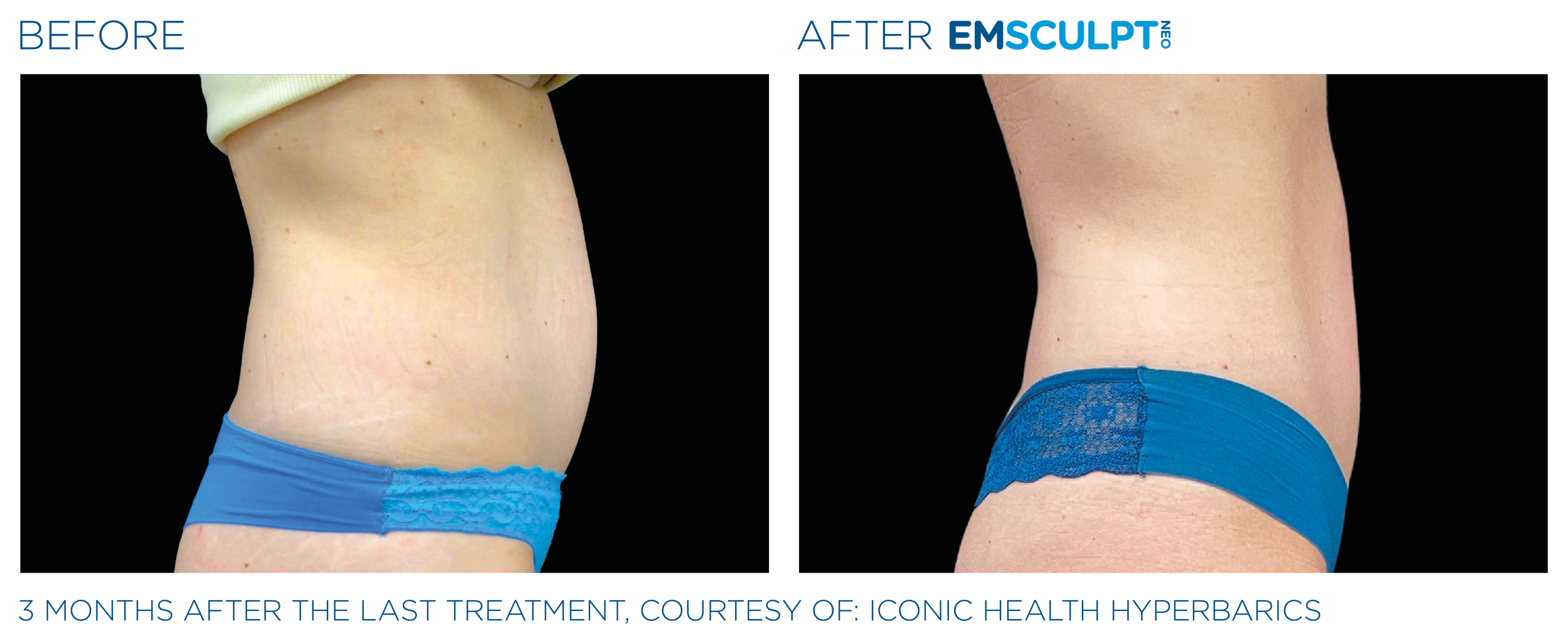 AbdomenEmsculpt_Neo_PIC_Ba-card-female-abdomen-138_ENUS100.png