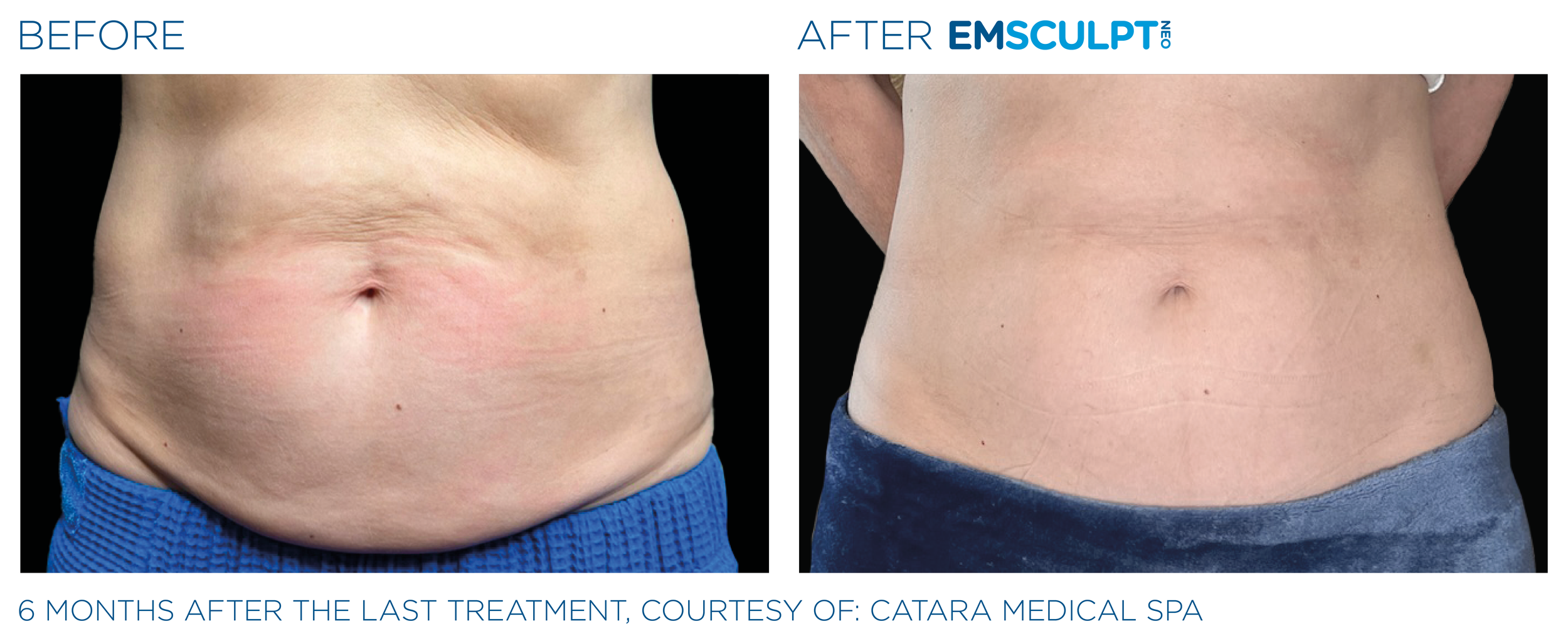 AbdomenEmsculpt_Neo_PIC_Ba-card-female-abdomen-139_ENUS100.png