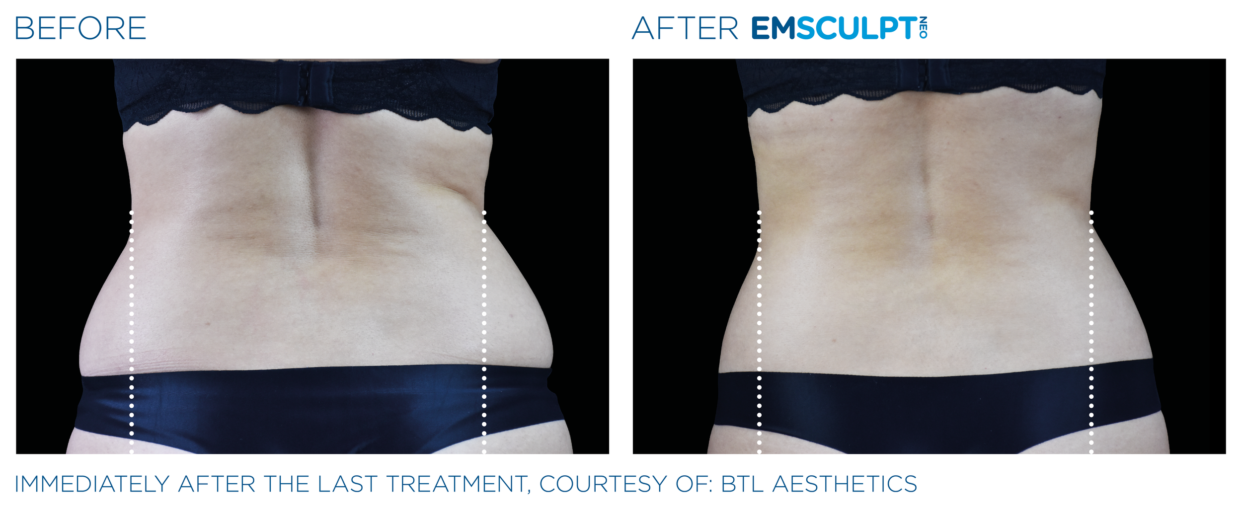 AbdomenEmsculpt_Neo_PIC_Ba-card-female-lateral-abdomen-101_ENUS100.png