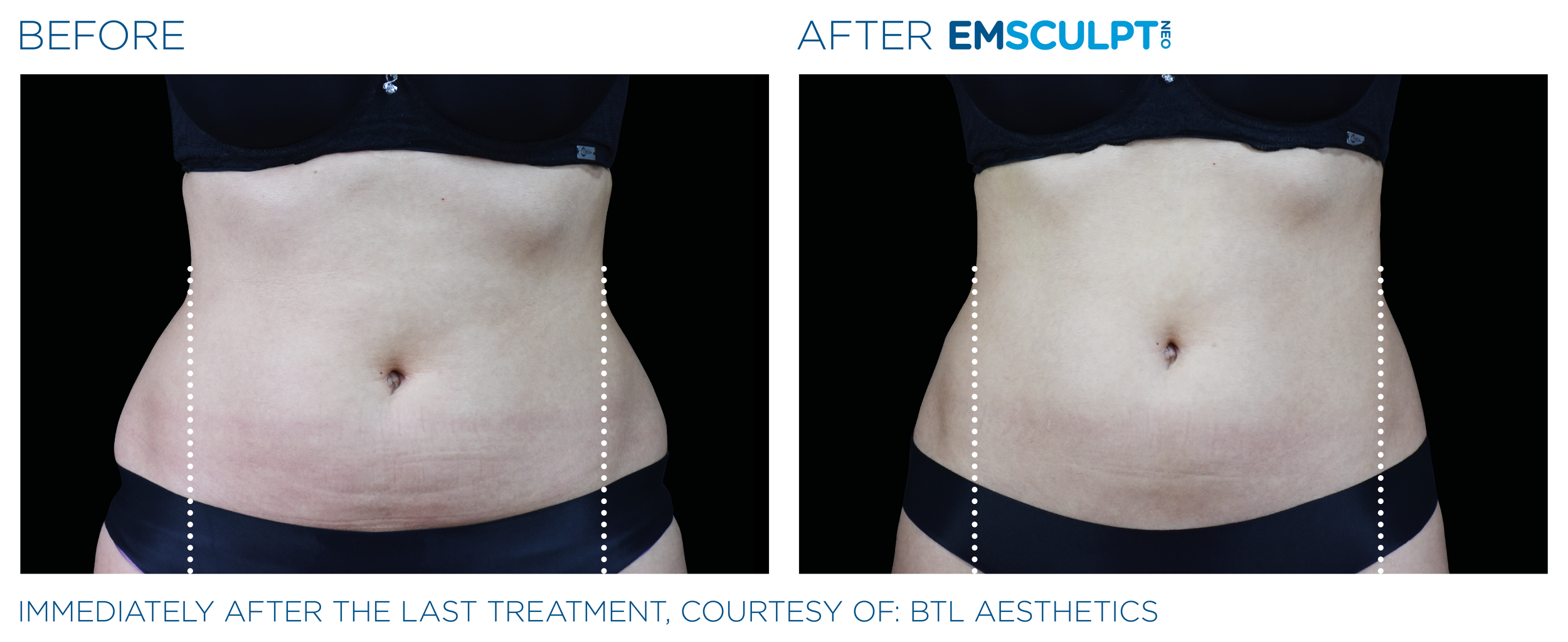 AbdomenEmsculpt_Neo_PIC_Ba-card-female-lateral-abdomen-102_ENUS100.png
