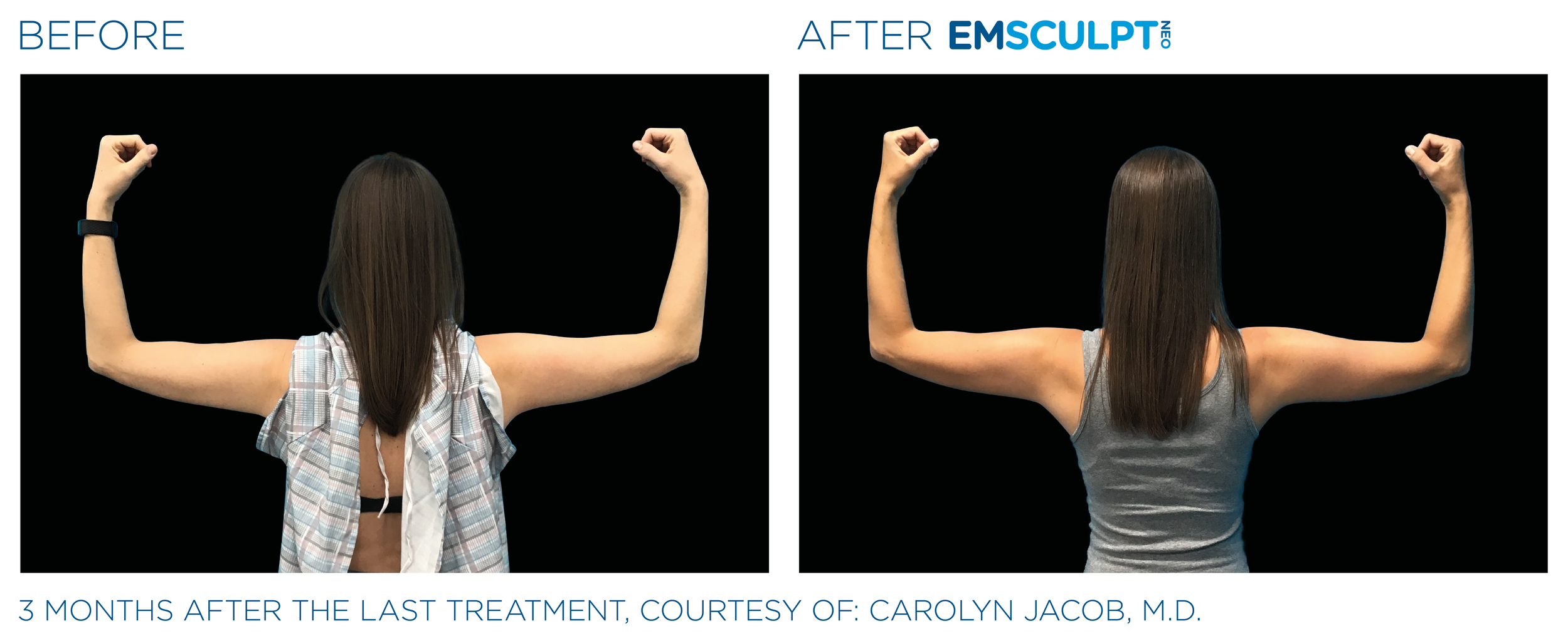 ArmsEmsculpt_Neo_PIC_Ba-card-female-arms-079-B_ENUS100.png