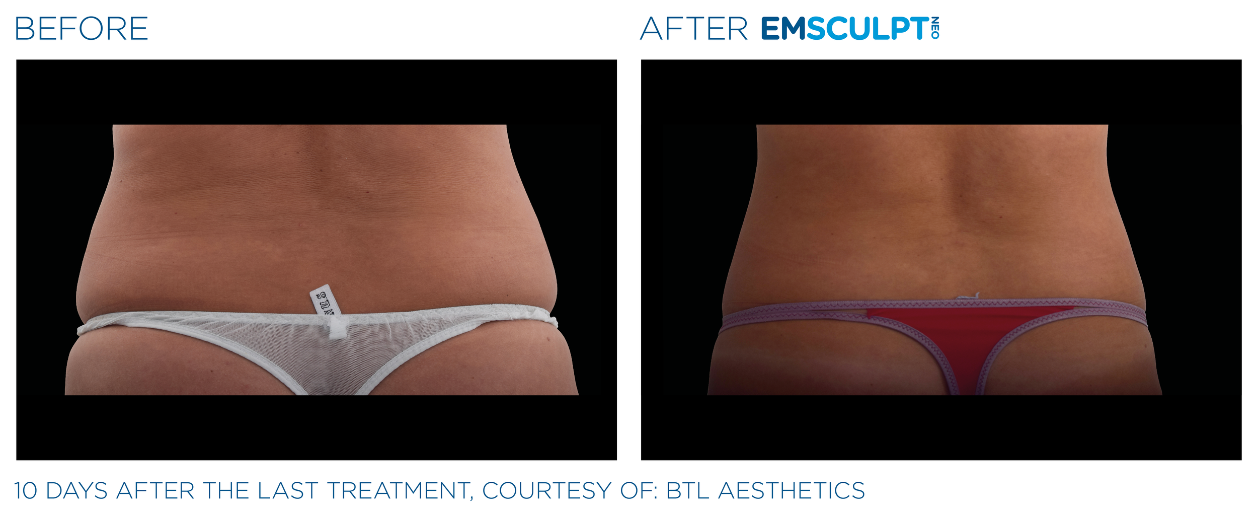 AbdomenEmsculpt_Neo_PIC_Ba-card-female-lateral-abdomen-104_ENUS100.png