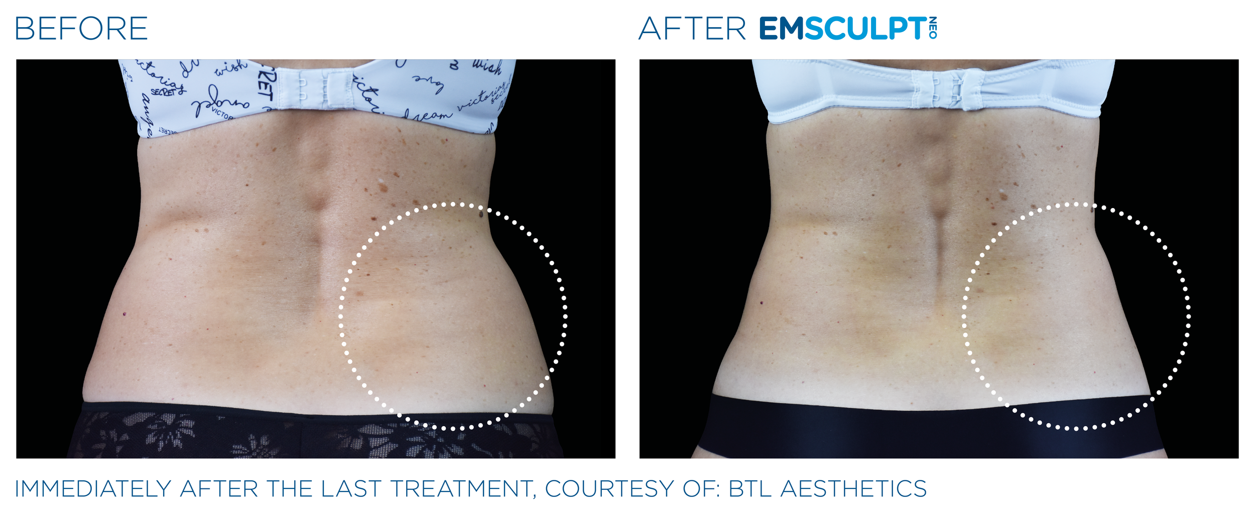 AbdomenEmsculpt_Neo_PIC_Ba-card-female-lateral-abdomen-103_ENUS100.png