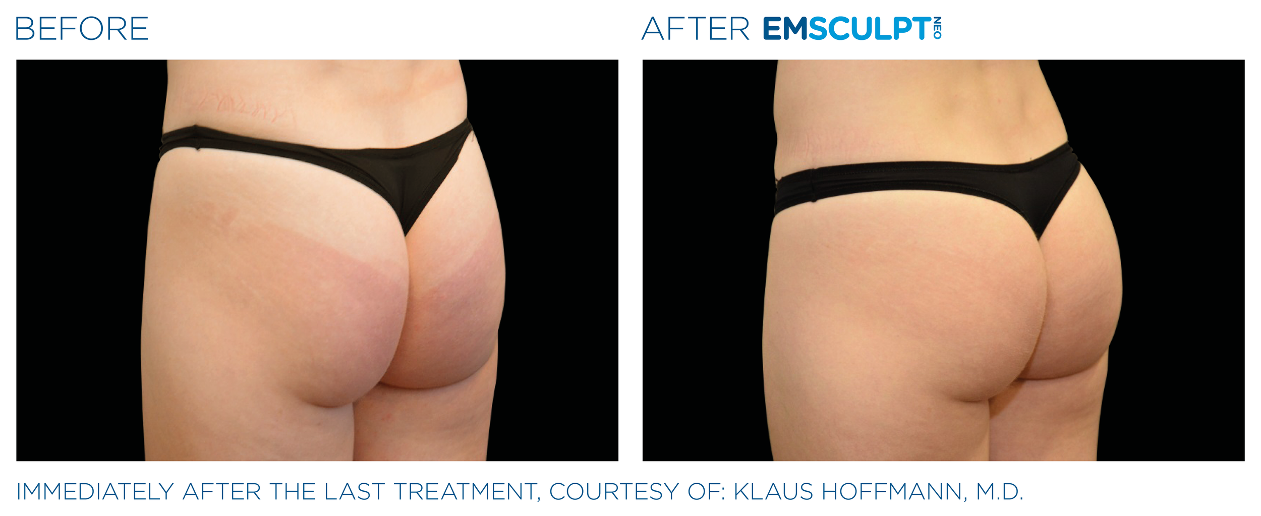 ButtocksEmsculpt_Neo_PIC_Ba-card-female-buttock-045_ENUS100.png
