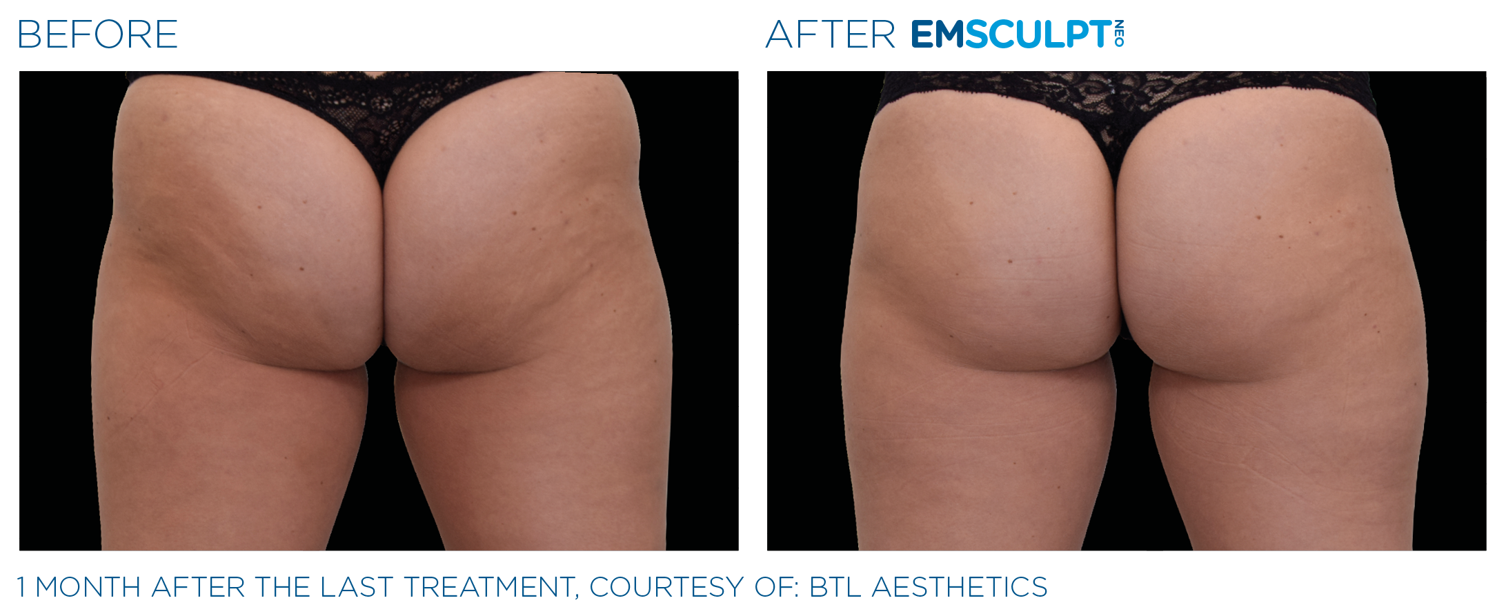 ButtocksEmsculpt_neo_PIC_Ba-card-female-buttock-061_ENUS100.png