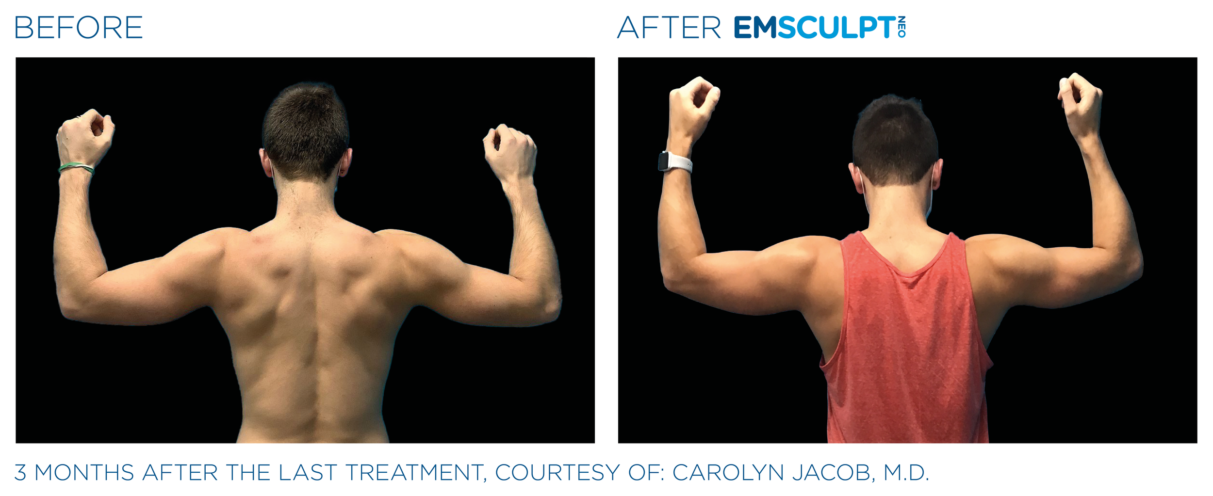 ArmsEmsculpt_Neo_PIC_Ba-card-male-arms-077-B_ENUS100.png