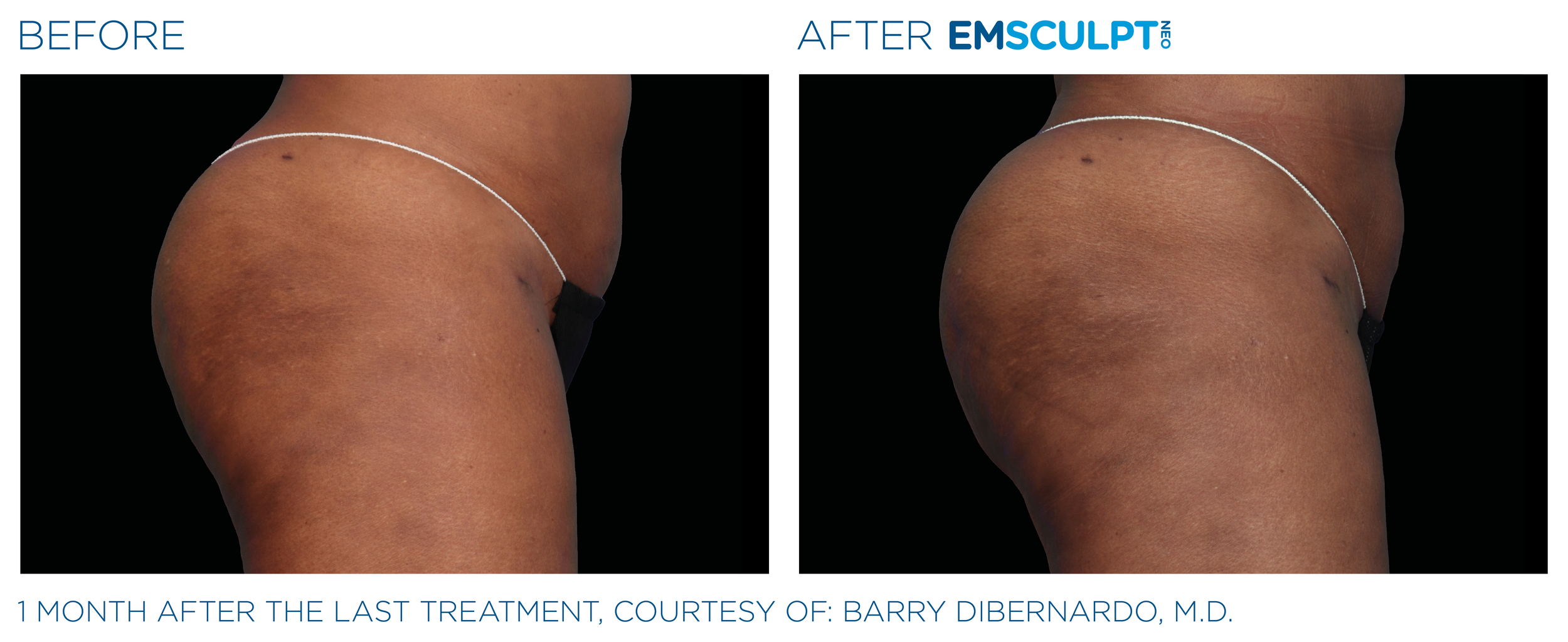 ButtocksEmsculpt_Neo_PIC_Ba-card-female-buttock-071_ENUS100.png
