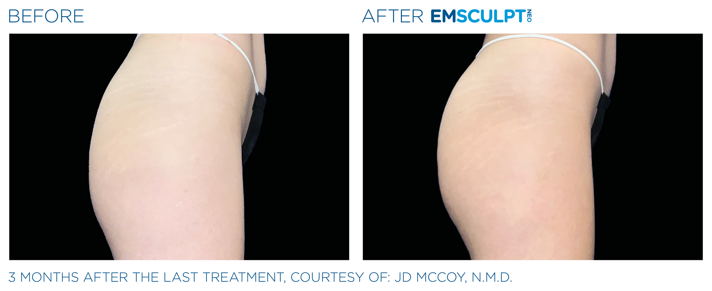 ButtocksEmsculpt_Neo_PIC_Ba-card-female-buttock-074_ENUS100.png