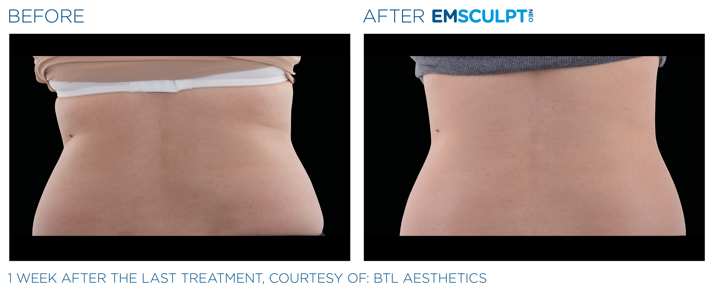 AbdomenEmsculpt_Neo_PIC_Ba-card-female-lateral-abdomen-112_ENUS100.png
