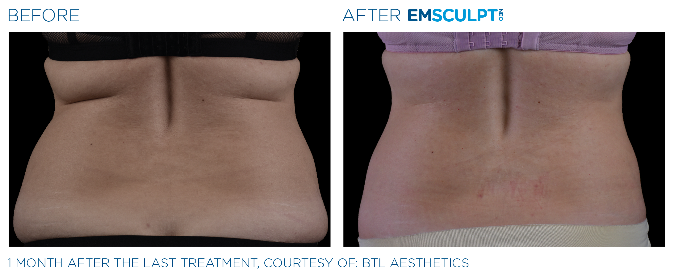 AbdomenEmsculpt_Neo_PIC_Ba-card-female-lateral-abdomen-116_ENUS100.png