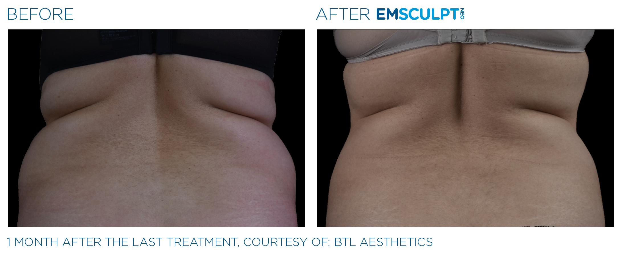 AbdomenEmsculpt_Neo_PIC_Ba-card-female-lateral-abdomen-118_ENUS100.png