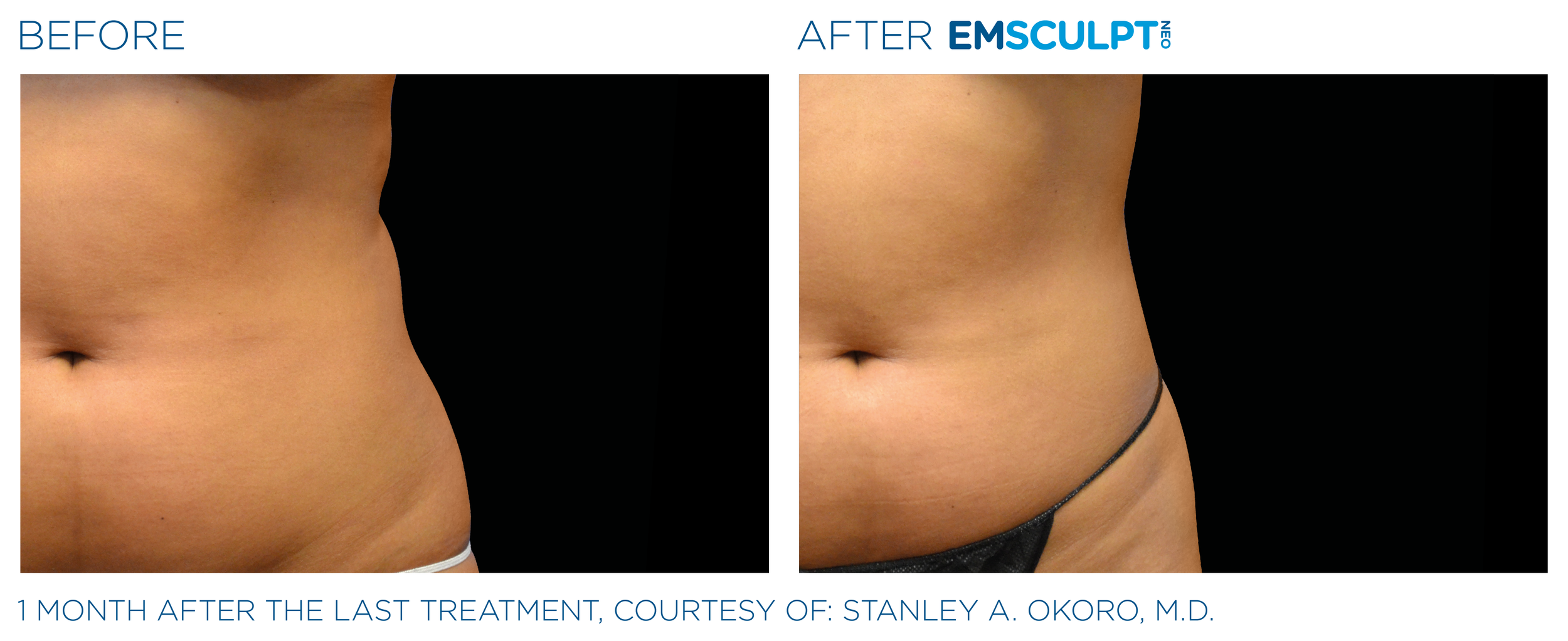 AbdomenEmsculpt_Neo_PIC_Ba-card-female-lateral-abdomen-127_ENUS100.png