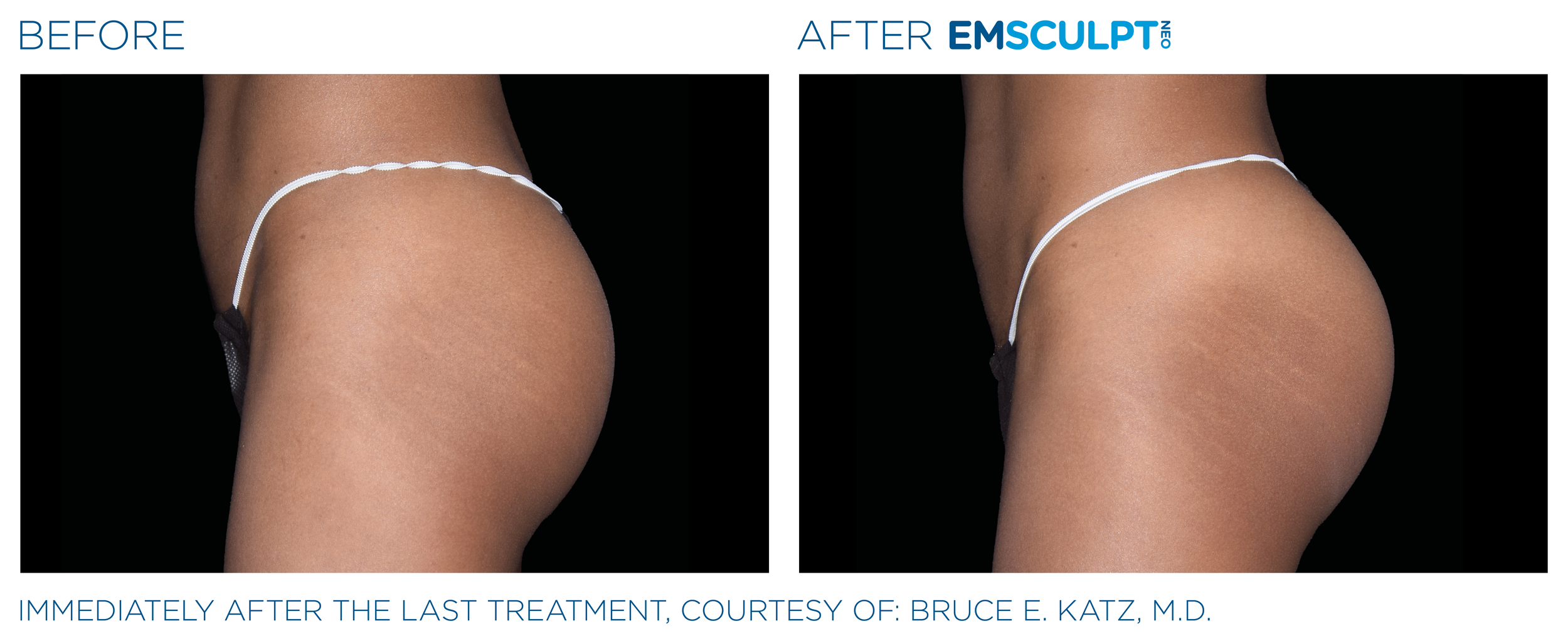 ButtocksEmsculpt_Neo_PIC_Ba-card-female-buttock-087_ENUS100.png