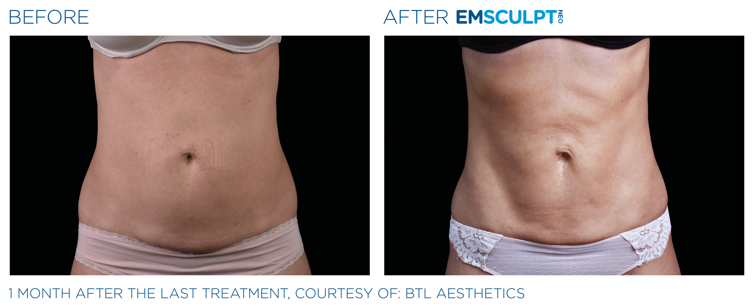 AbdomenEmsculpt_Neo_PIC_Ba-card-female-lateral-abdomen-120_ENUS100.png