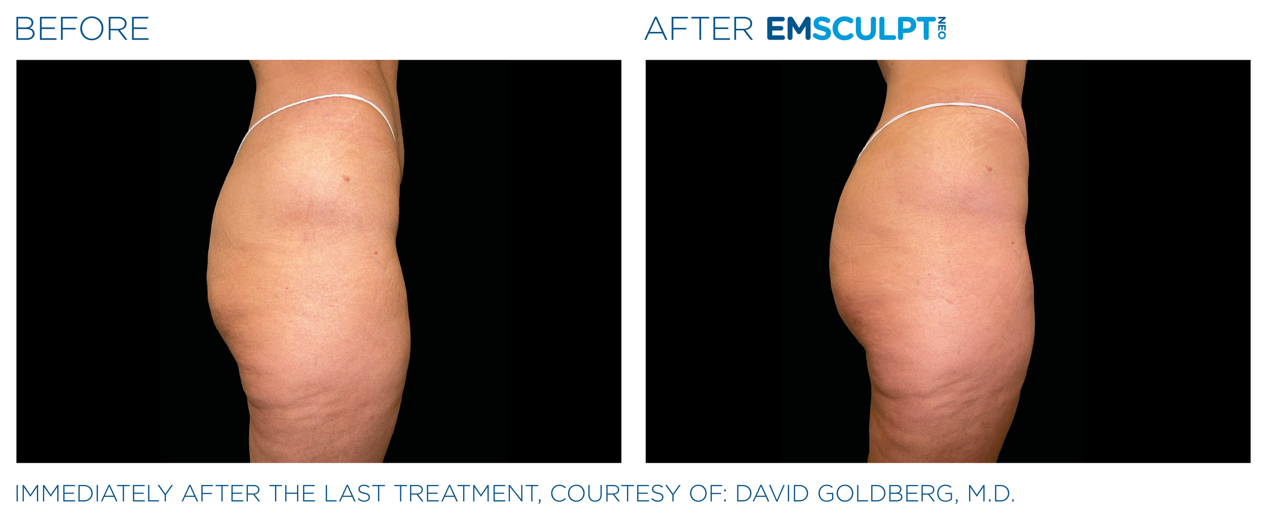 ButtocksEmsculpt_Neo_PIC_Ba-card-female-buttock-073_ENUS100.png