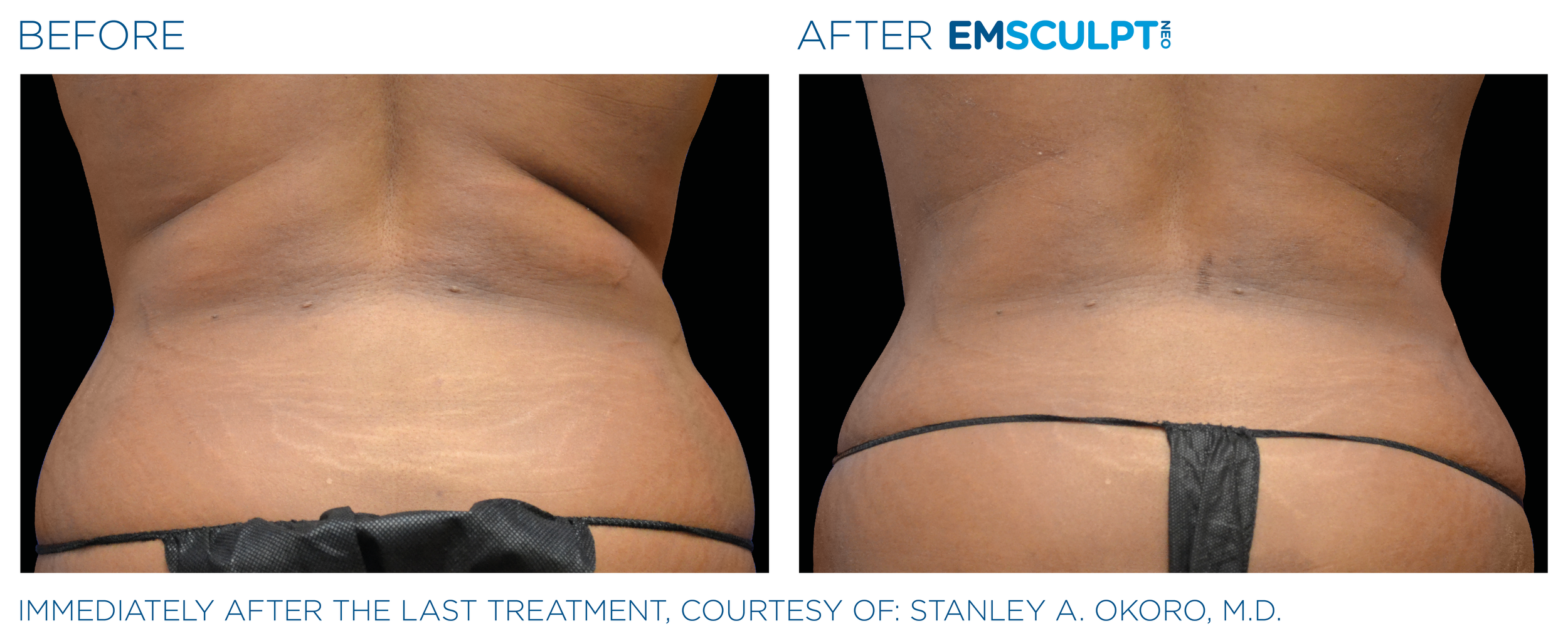 AbdomenEmsculpt_Neo_PIC_Ba-card-female-lateral-abdomen-128_ENUS100.png