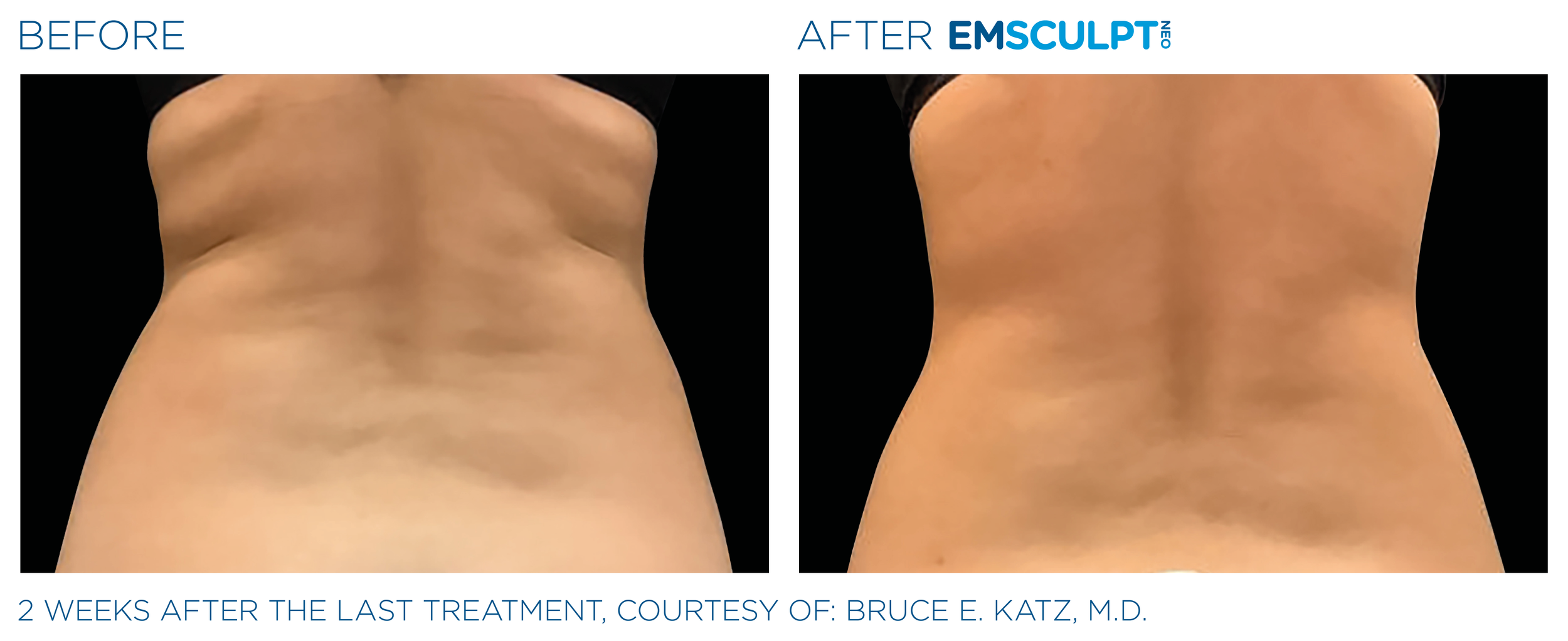 AbdomenEmsculpt_Neo_PIC_Ba-card-female-lateral-abdomen-135_ENUS100.png