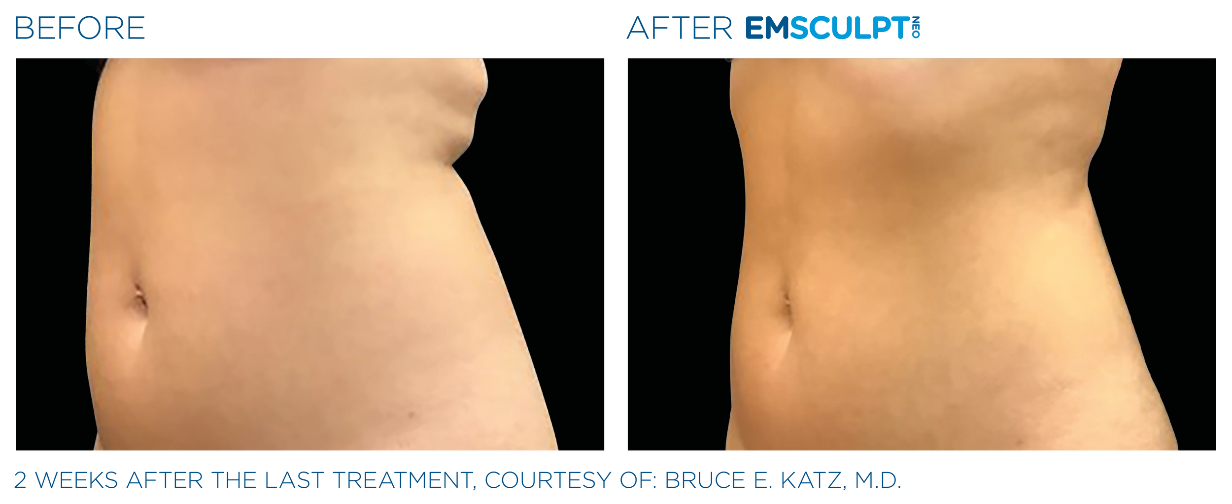 AbdomenEmsculpt_Neo_PIC_Ba-card-female-lateral-abdomen-136_ENUS100.png