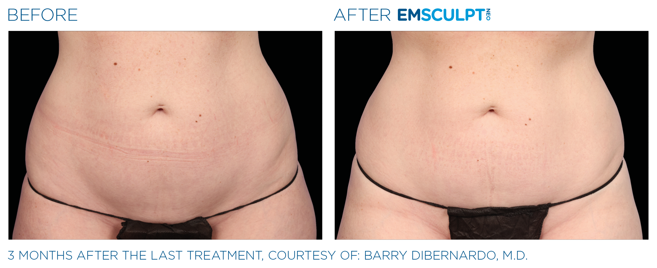 AbdomenEmsculpt_Neo_PIC_Ba-card-female-lateral-abdomen-141_ENUS100.png