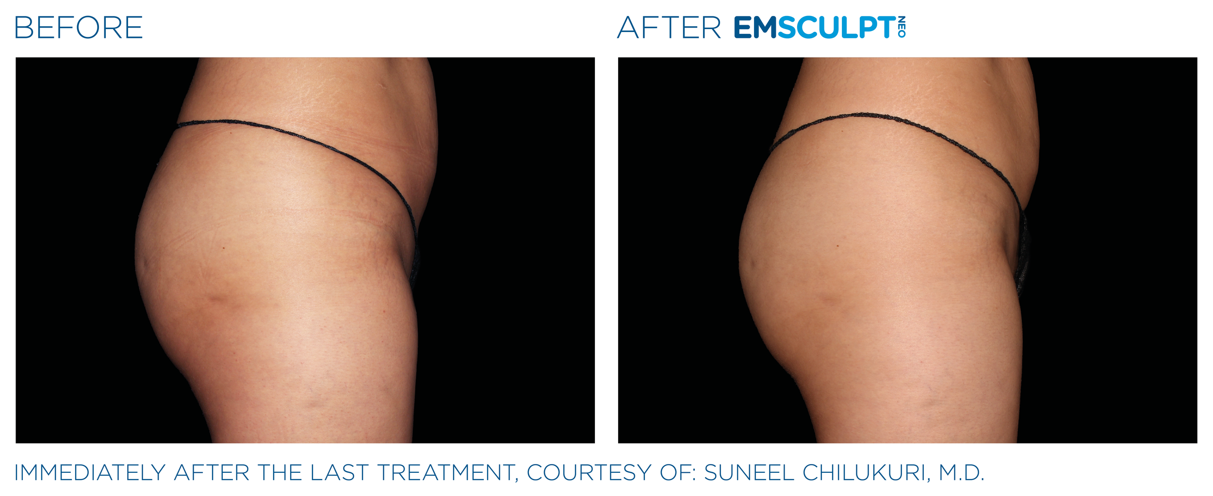 ButtocksEmsculpt_Neo_PIC_Ba-card-female-buttock-076_ENUS100.png