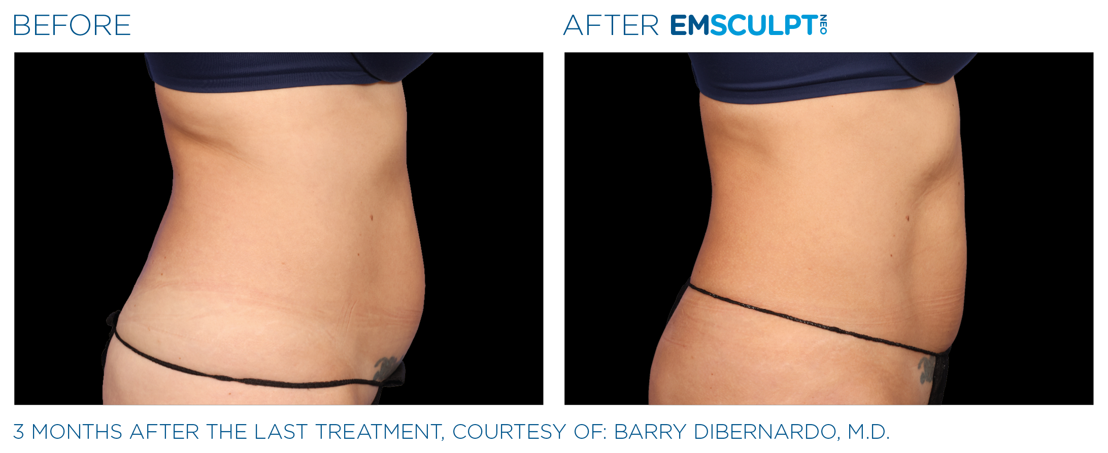 AbdomenEmsculpt_Neo_PIC_Ba-card-female-lateral-abdomen-142_ENUS100.png