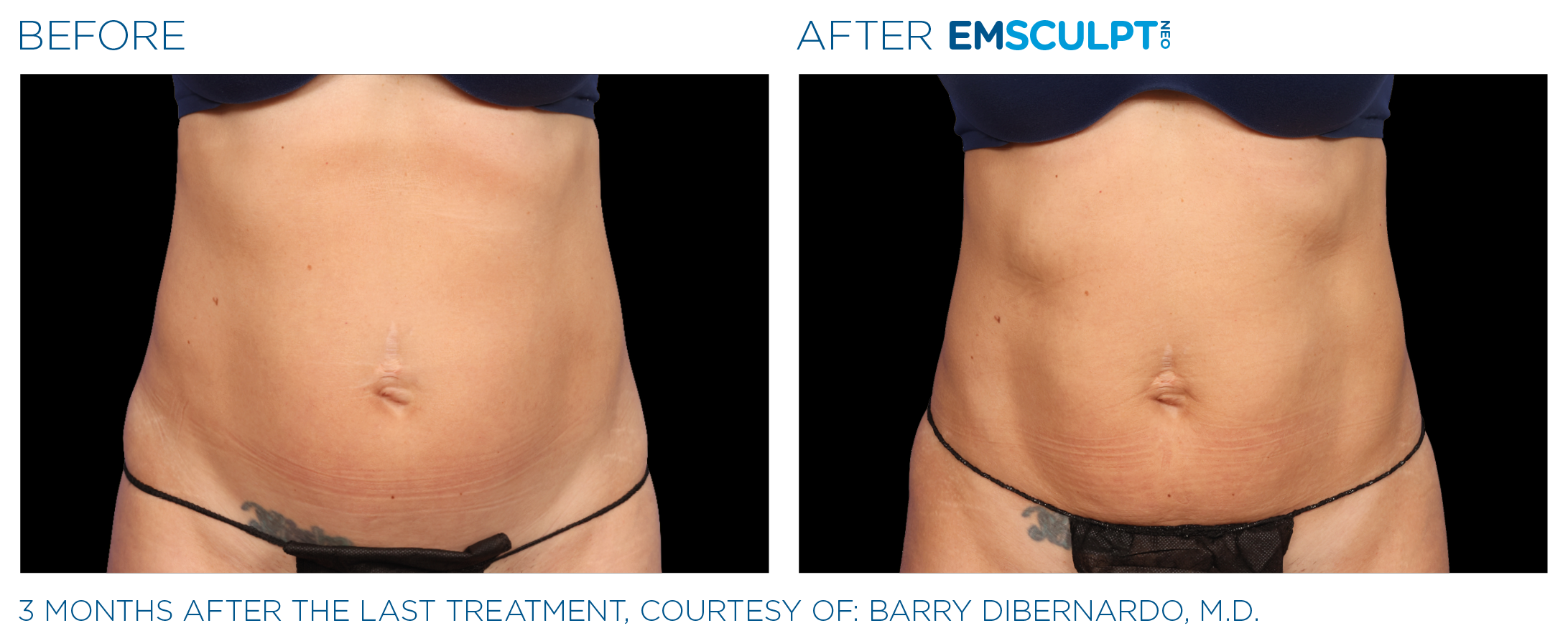 AbdomenEmsculpt_Neo_PIC_Ba-card-female-lateral-abdomen-143_ENUS100.png