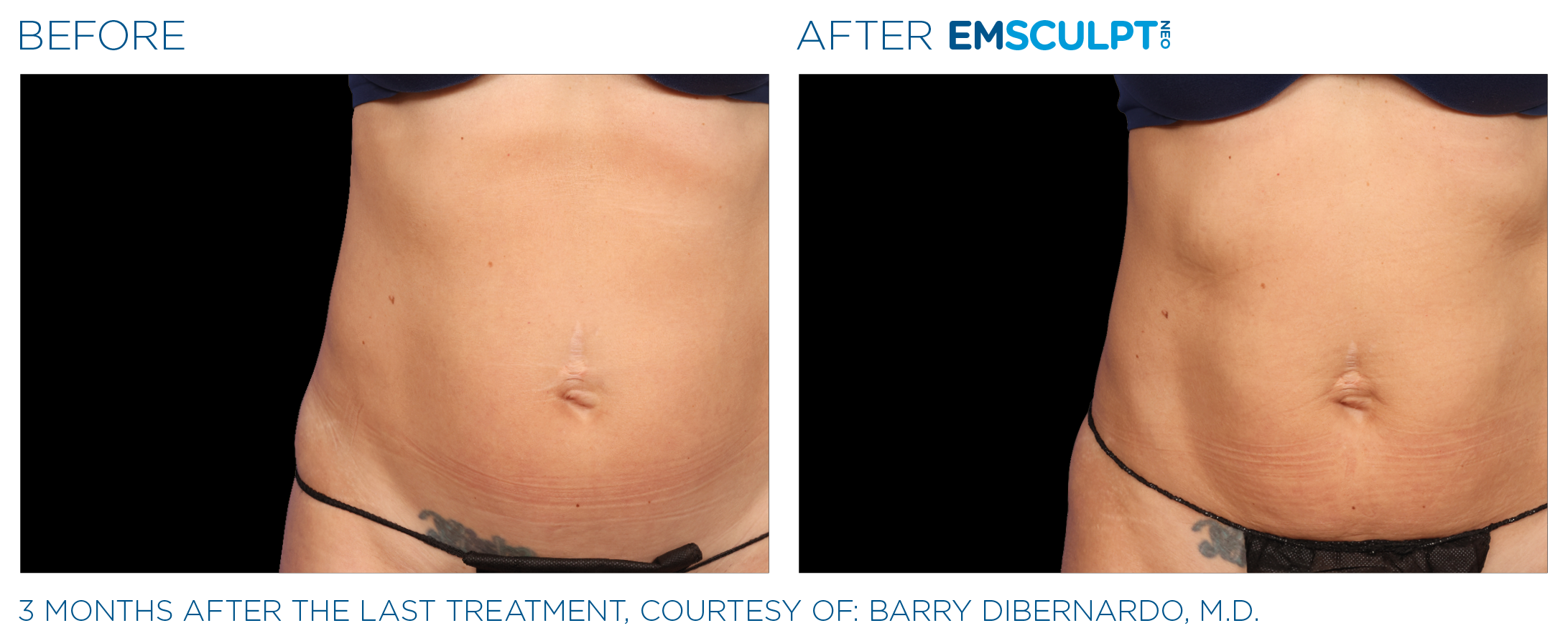AbdomenEmsculpt_Neo_PIC_Ba-card-female-lateral-abdomen-144_ENUS100.png