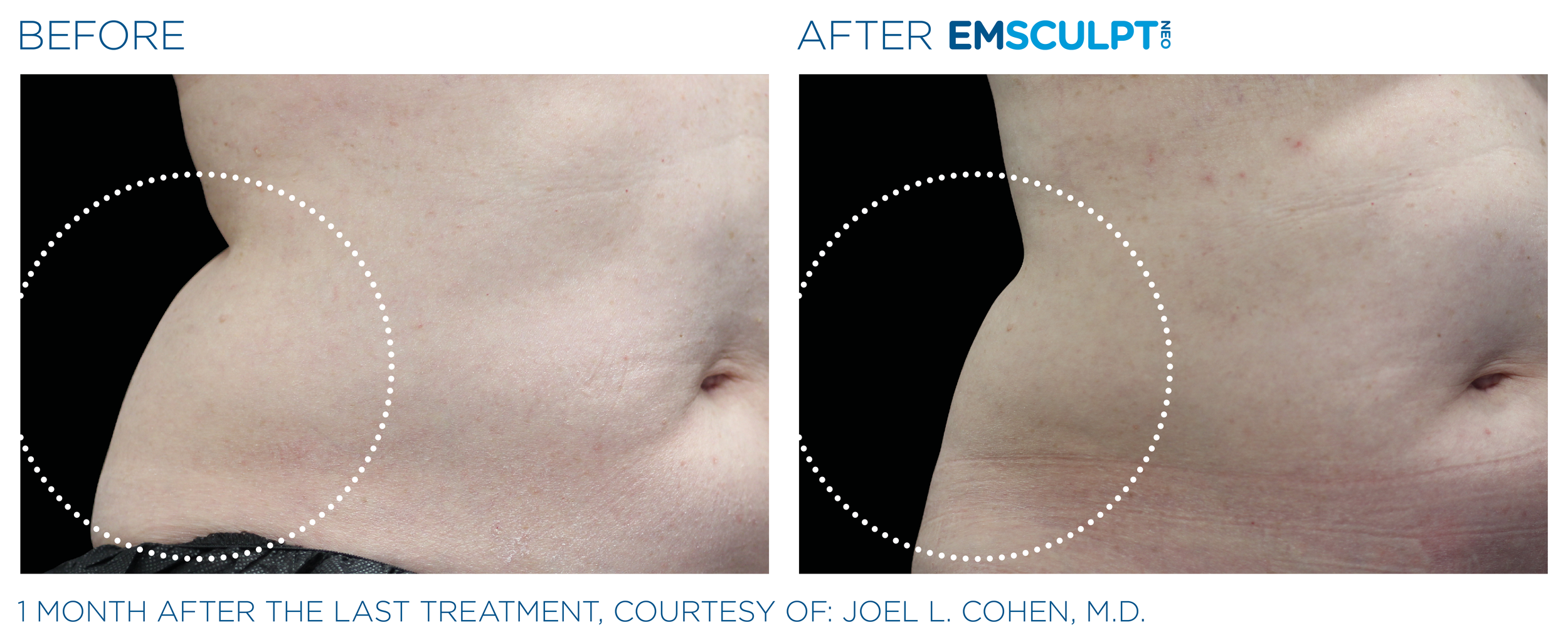 AbdomenEmsculpt_Neo_PIC_Ba-card-female-lateral-abdomen-129_ENUS100.png