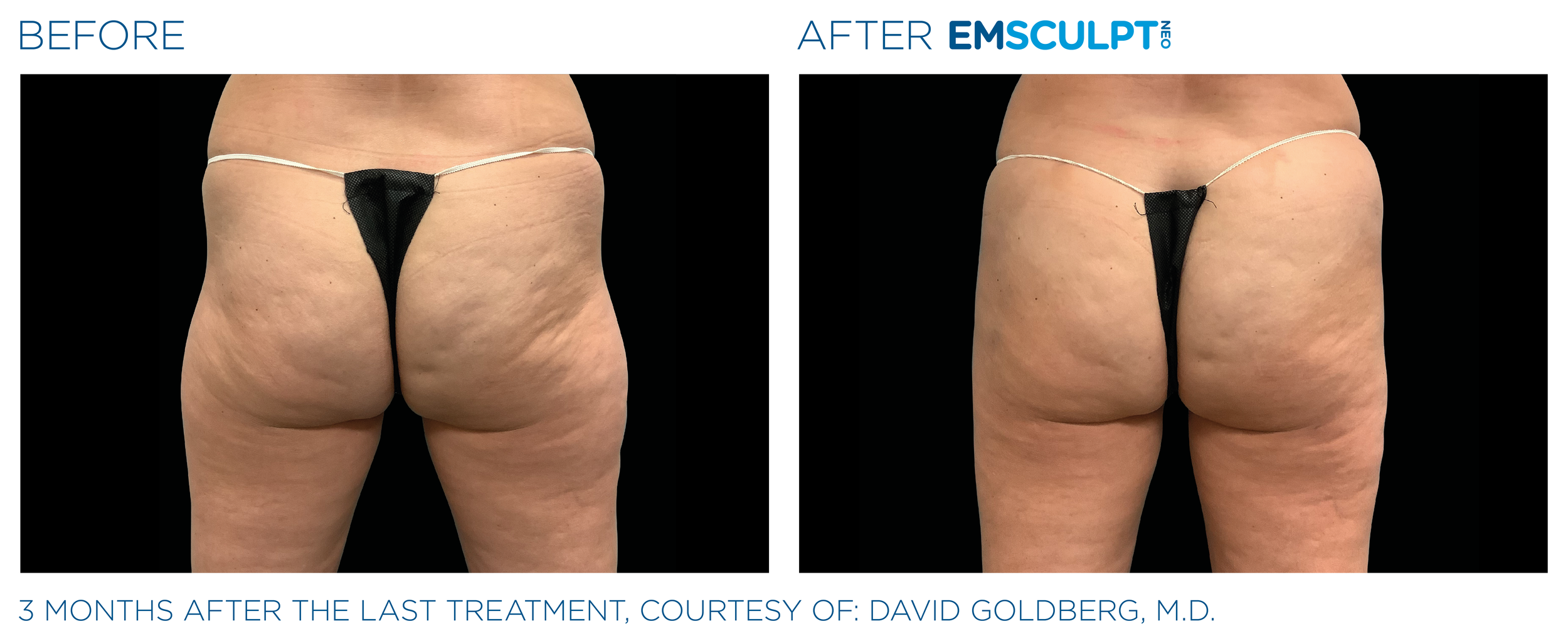 ButtocksEmsculpt_Neo_PIC_Ba-card-female-buttock-097_ENUS100.png