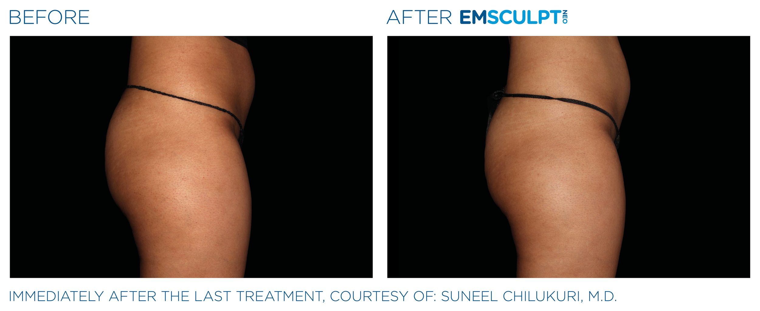 ButtocksEmsculpt_Neo_PIC_Ba-card-female-buttock-089_ENUS100.png