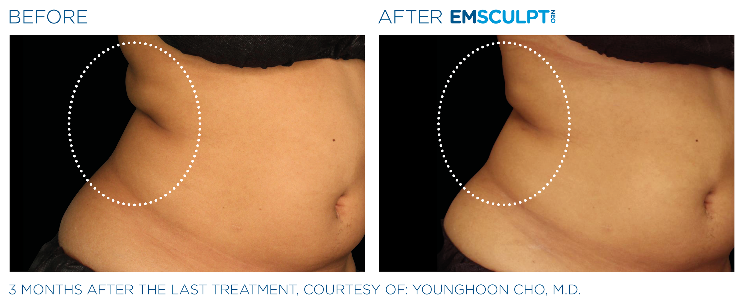 AbdomenEmsculpt_Neo_PIC_Ba-card-female-lateral-abdomen-145_ENUS100.png