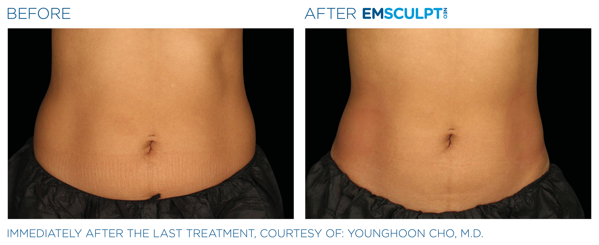 AbdomenEmsculpt_Neo_PIC_Ba-card-female-lateral-abdomen-150_ENUS100.png