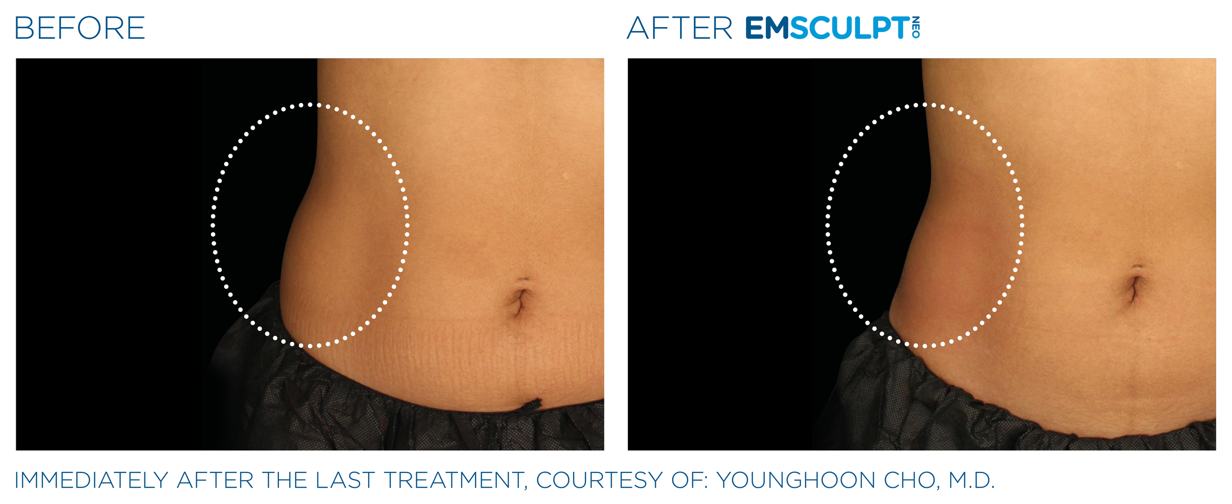 AbdomenEmsculpt_Neo_PIC_Ba-card-female-lateral-abdomen-151_ENUS100.png
