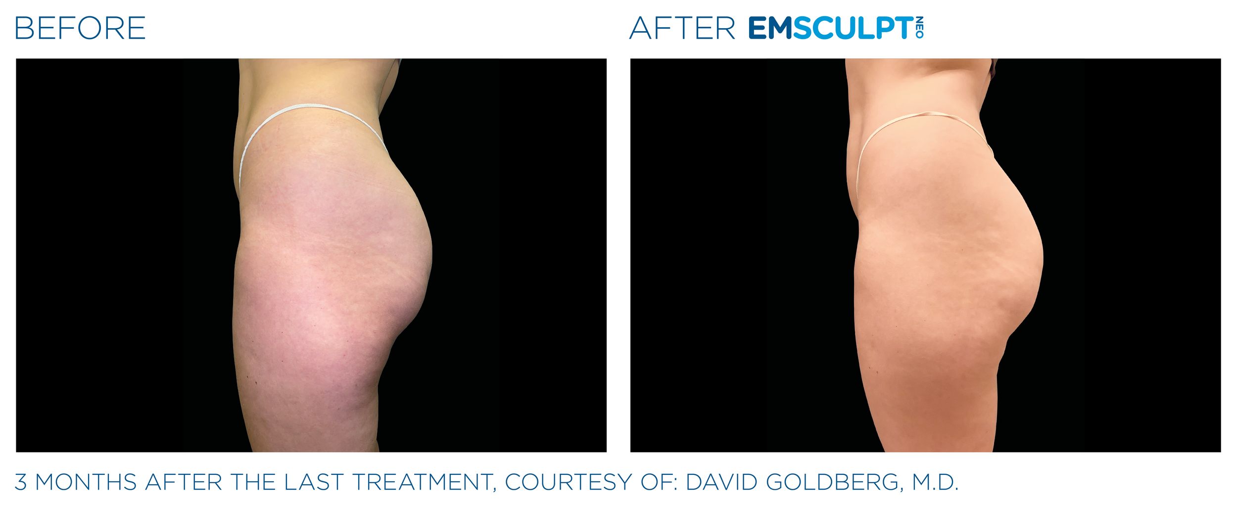 ButtocksEmsculpt_Neo_PIC_Ba-card-female-buttock-096_ENUS100.png