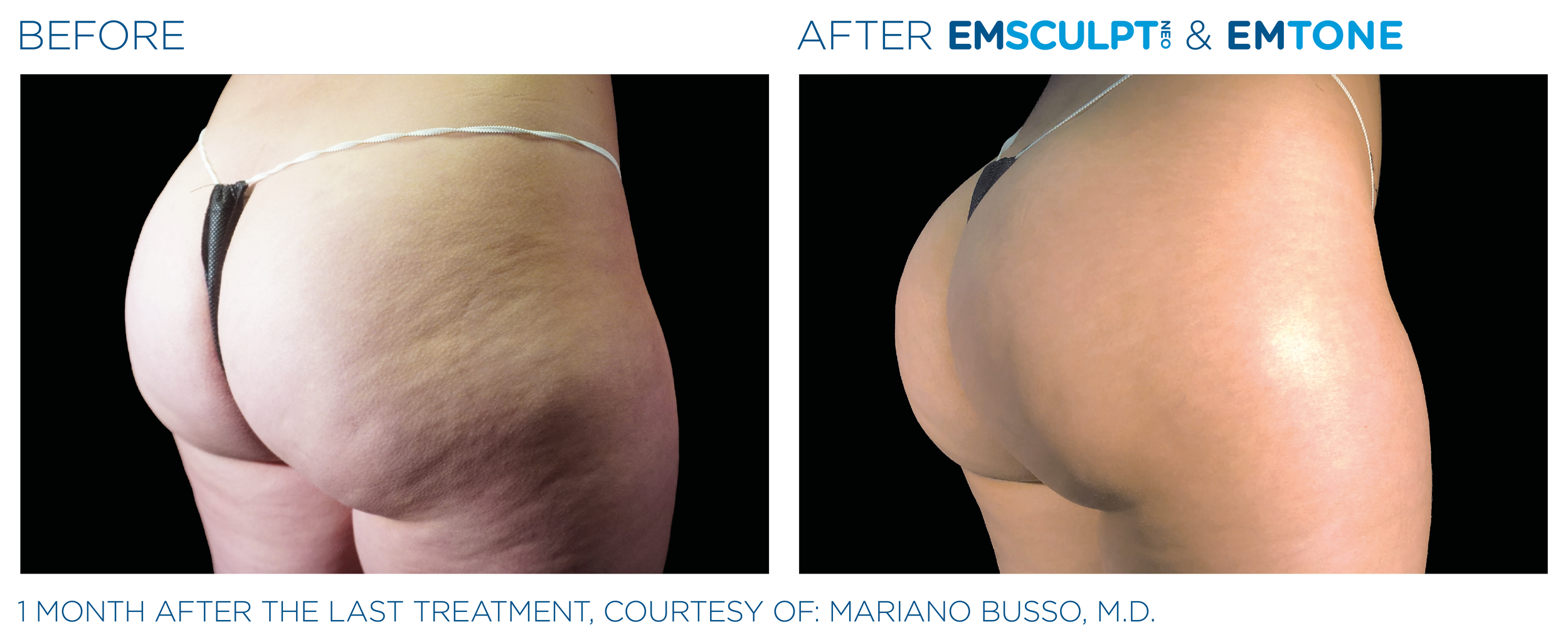 ButtocksEmsculpt_Neo-Emtone_PIC_Ba-card-female-buttock-008_ENUS100.png