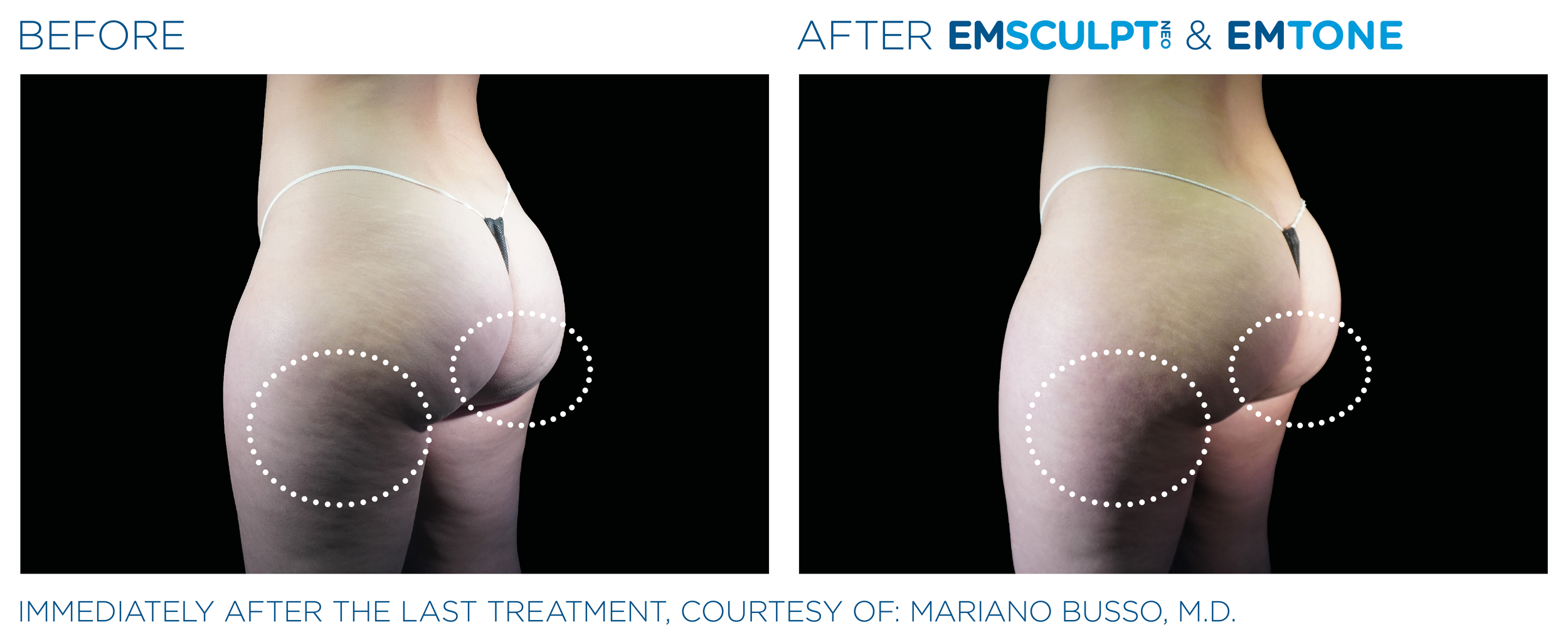 ButtocksEmsculpt_Neo-Emtone_PIC_Ba-card-female-buttock-012_ENUS100.png