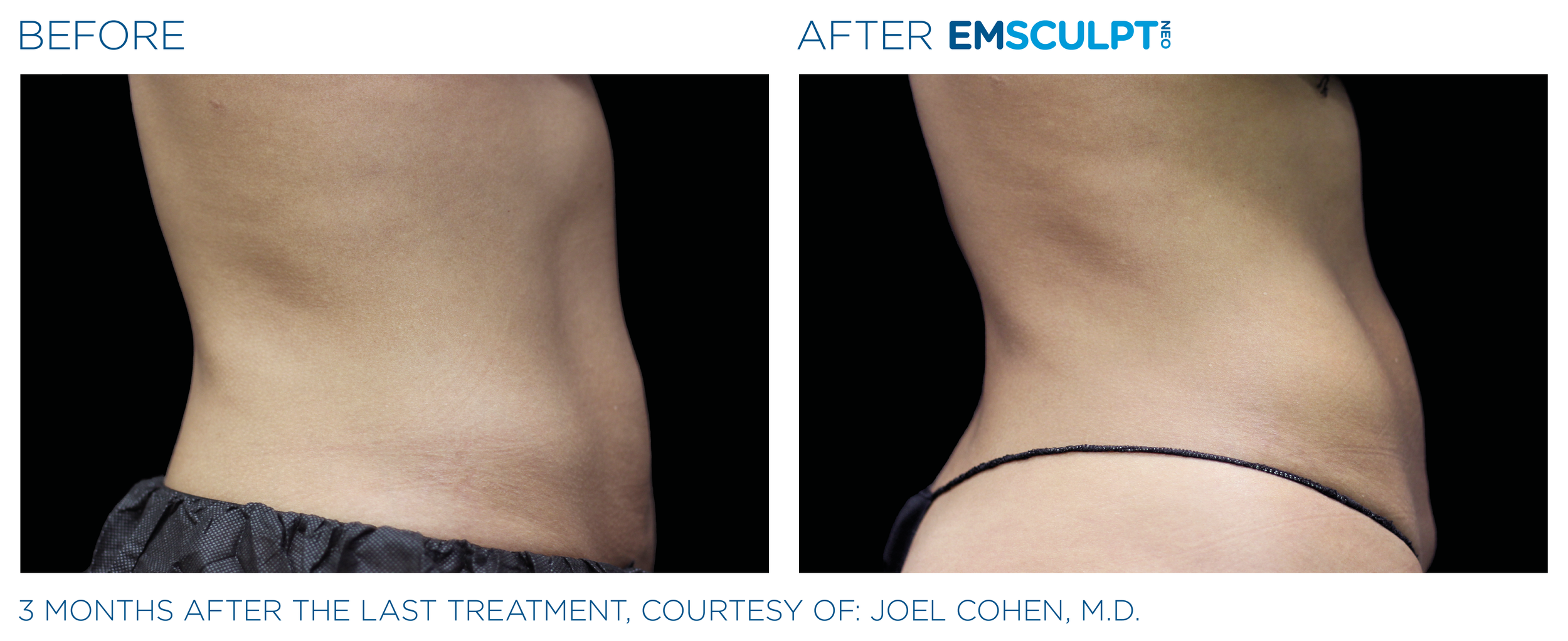 AbdomenEmsculpt_Neo_PIC_Ba-card-female-lateral-abdomen-153_ENUS100.png