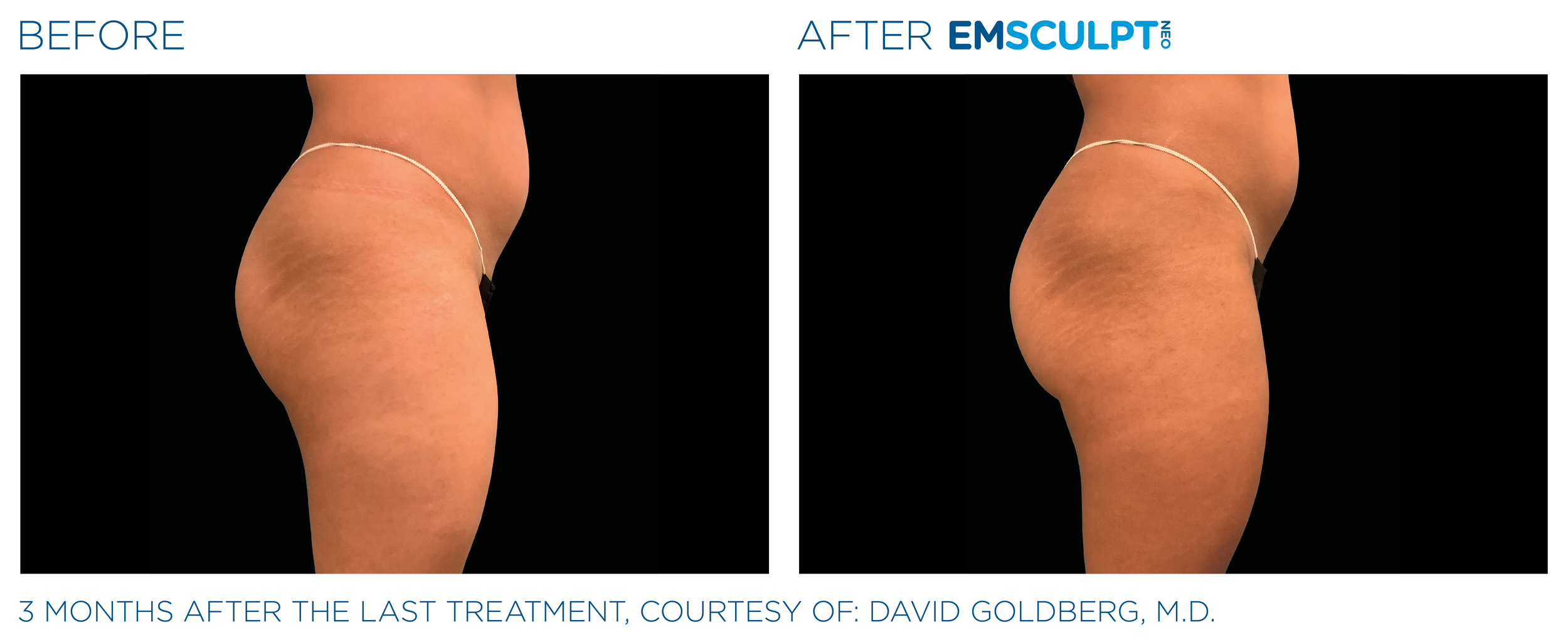 ButtocksEmsculpt_Neo_PIC_Ba-card-female-buttock-098_ENUS100.png