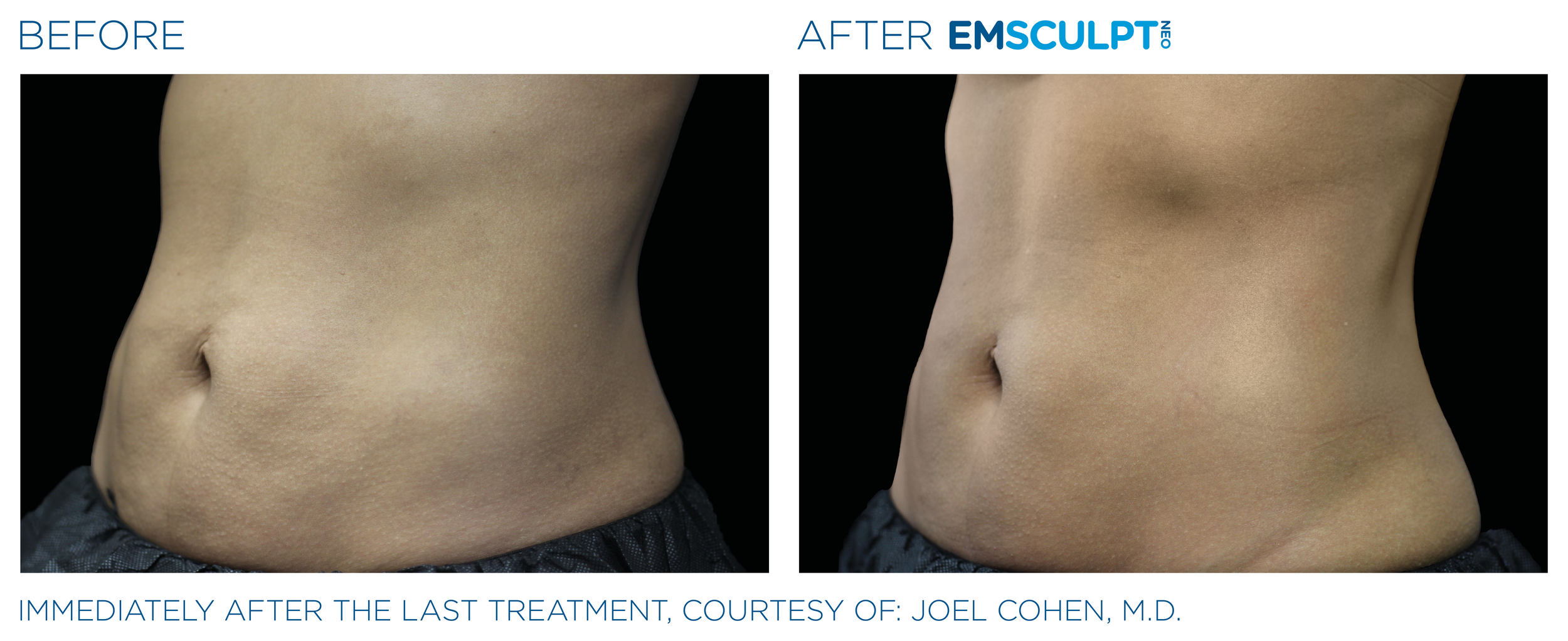 AbdomenEmsculpt_Neo_PIC_Ba-card-female-lateral-abdomen-154_ENUS100.png