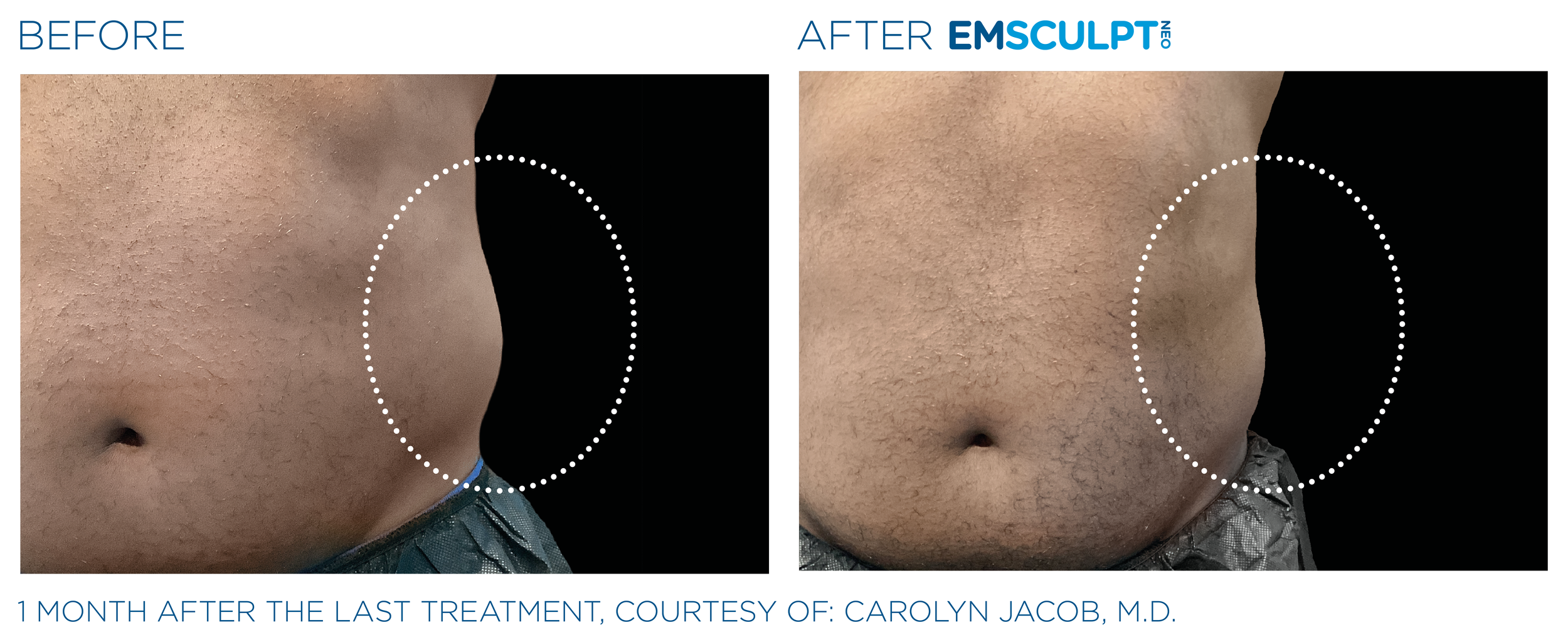 AbdomenEmsculpt_Neo_PIC_Ba-card-female-lateral-abdomen-158_ENUS100.png