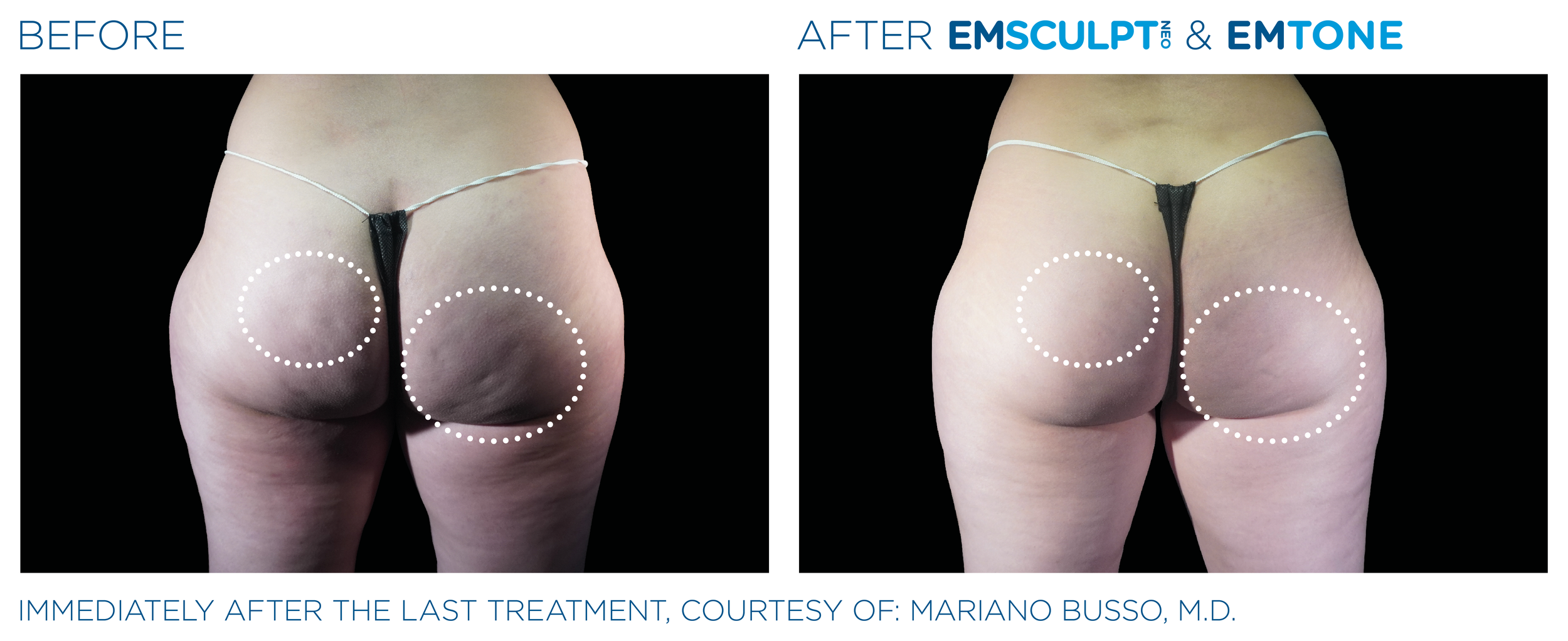ButtocksEmsculpt_Neo-Emtone_PIC_Ba-card-female-buttock-011_ENUS100.png