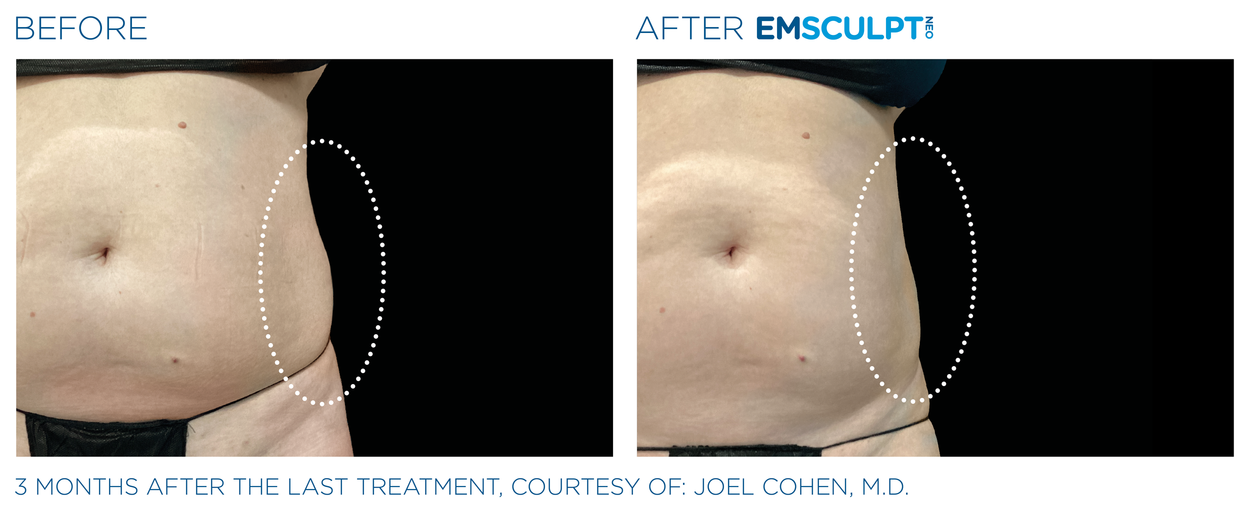 AbdomenEmsculpt_Neo_PIC_Ba-card-female-lateral-abdomen-162_ENUS100.png