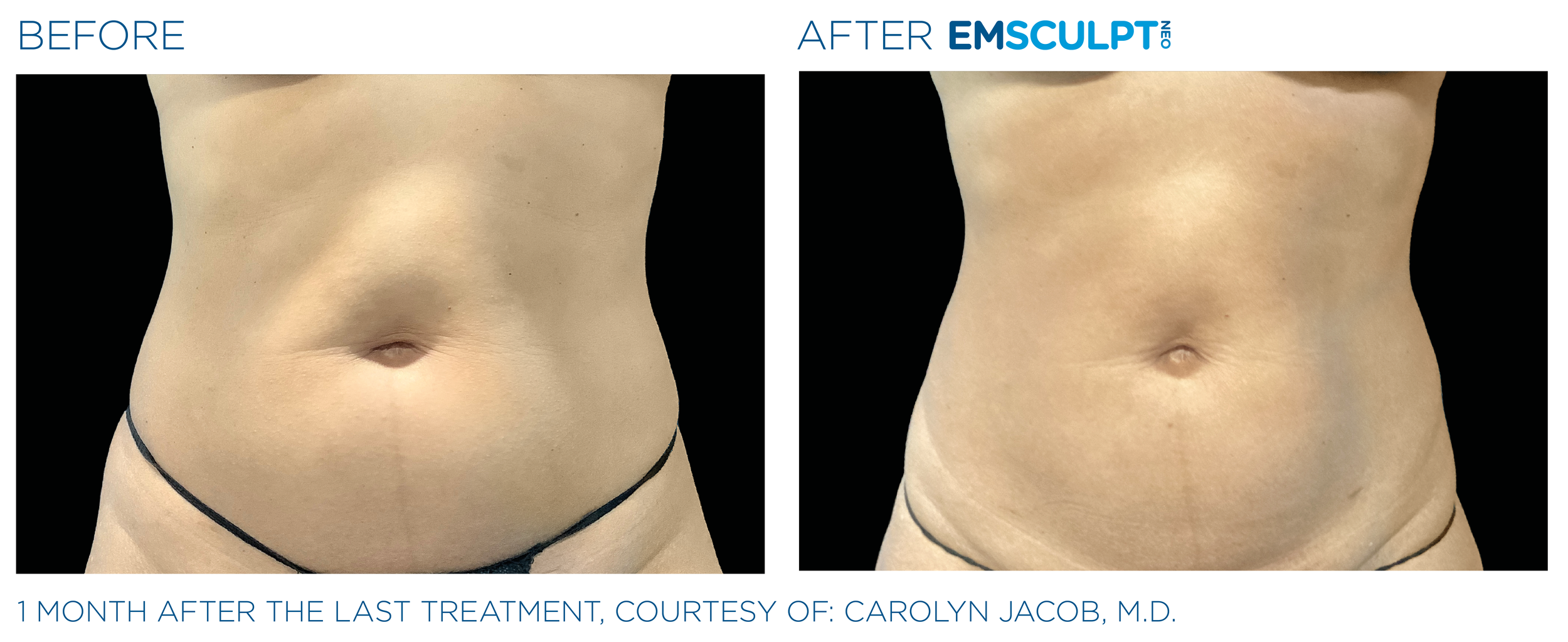 AbdomenEmsculpt_Neo_PIC_Ba-card-female-lateral-abdomen-159_ENUS100.png