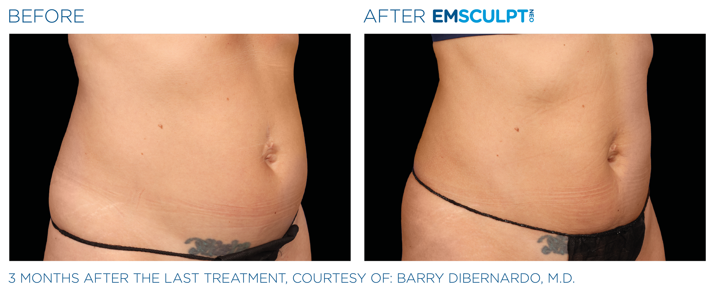 AbdomenEmsculpt_Neo_PIC_Ba-card-female-lateral-abdomen-168_ENUS100.png
