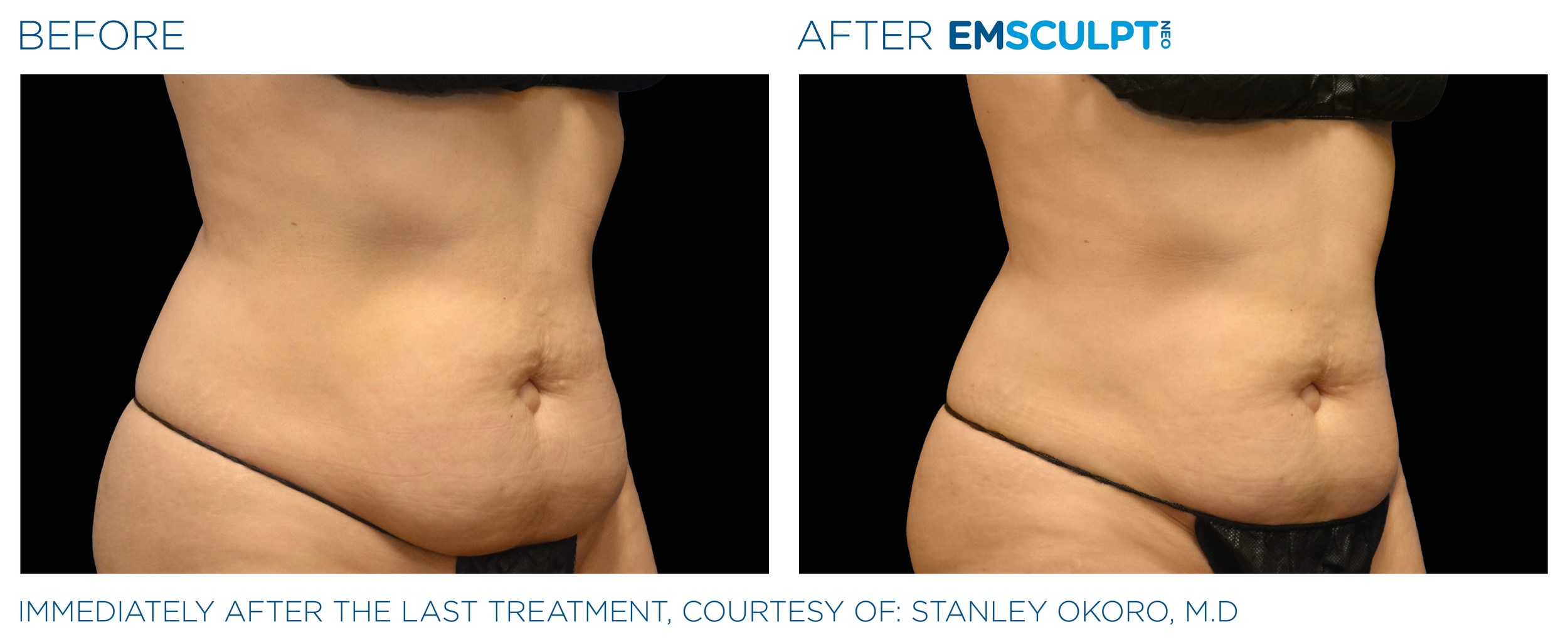 AbdomenEmsculpt_Neo_PIC_Ba-card-female-lateral-abdomen-172_ENUS100.png