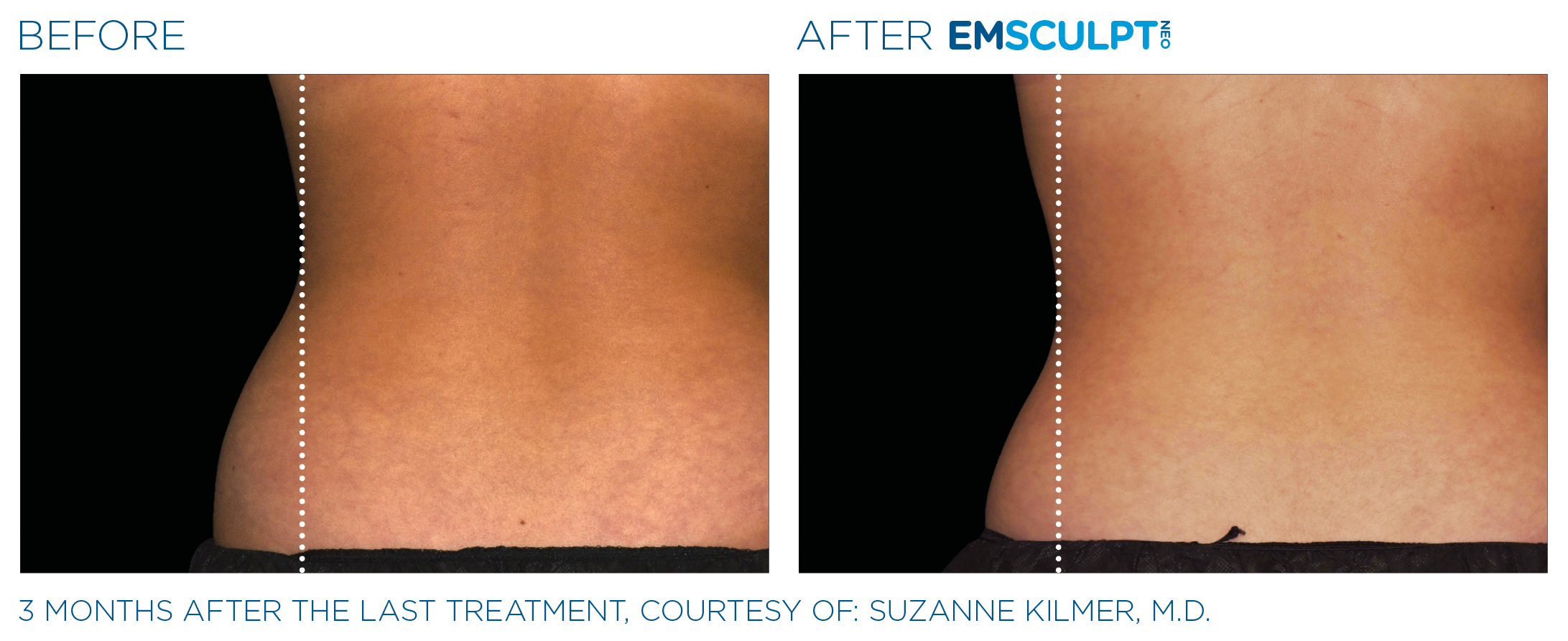 AbdomenEmsculpt_Neo_PIC_Ba-card-female-lateral-abdomen-176_ENUS100.png